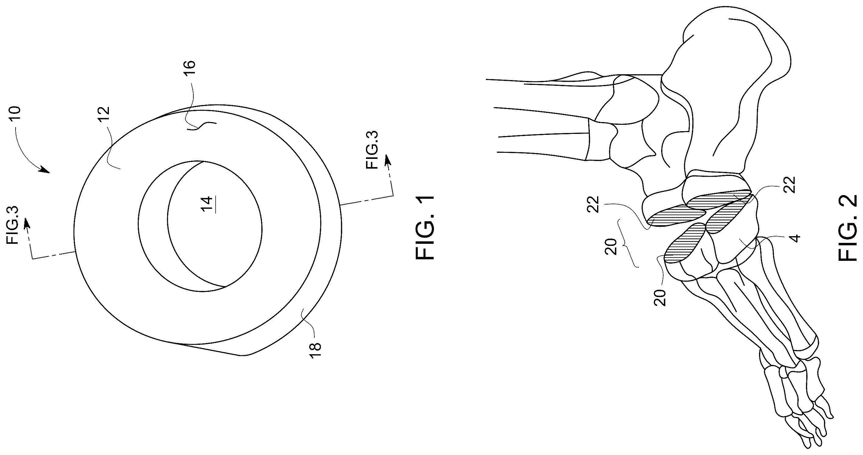 Patent US12496198 — Dowel guide instrument and method for treating mid-foot disorders — Figure 1