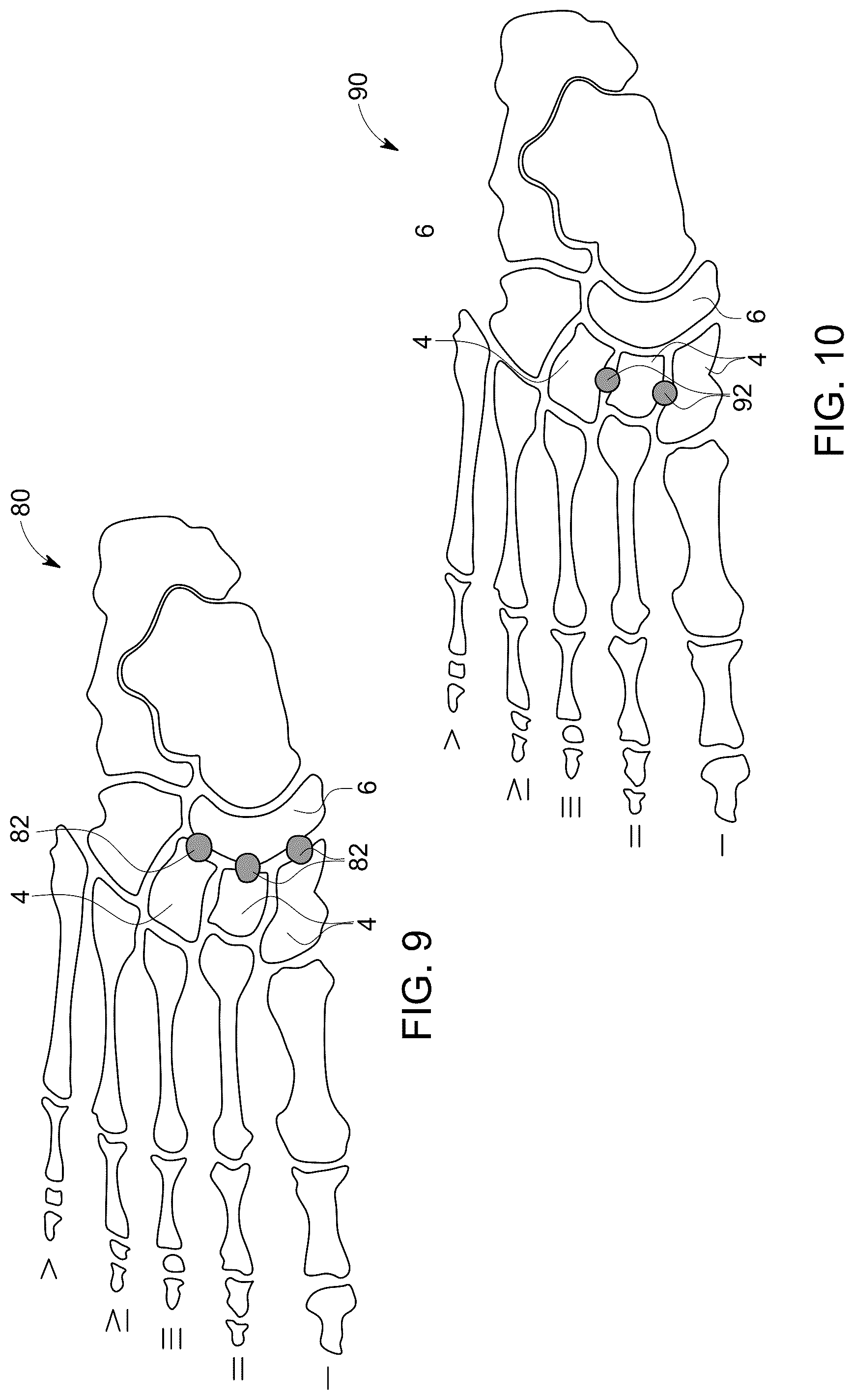 Patent US12496198 Figure 5 – Dowel guide instrument and method for treating mid-foot disorders