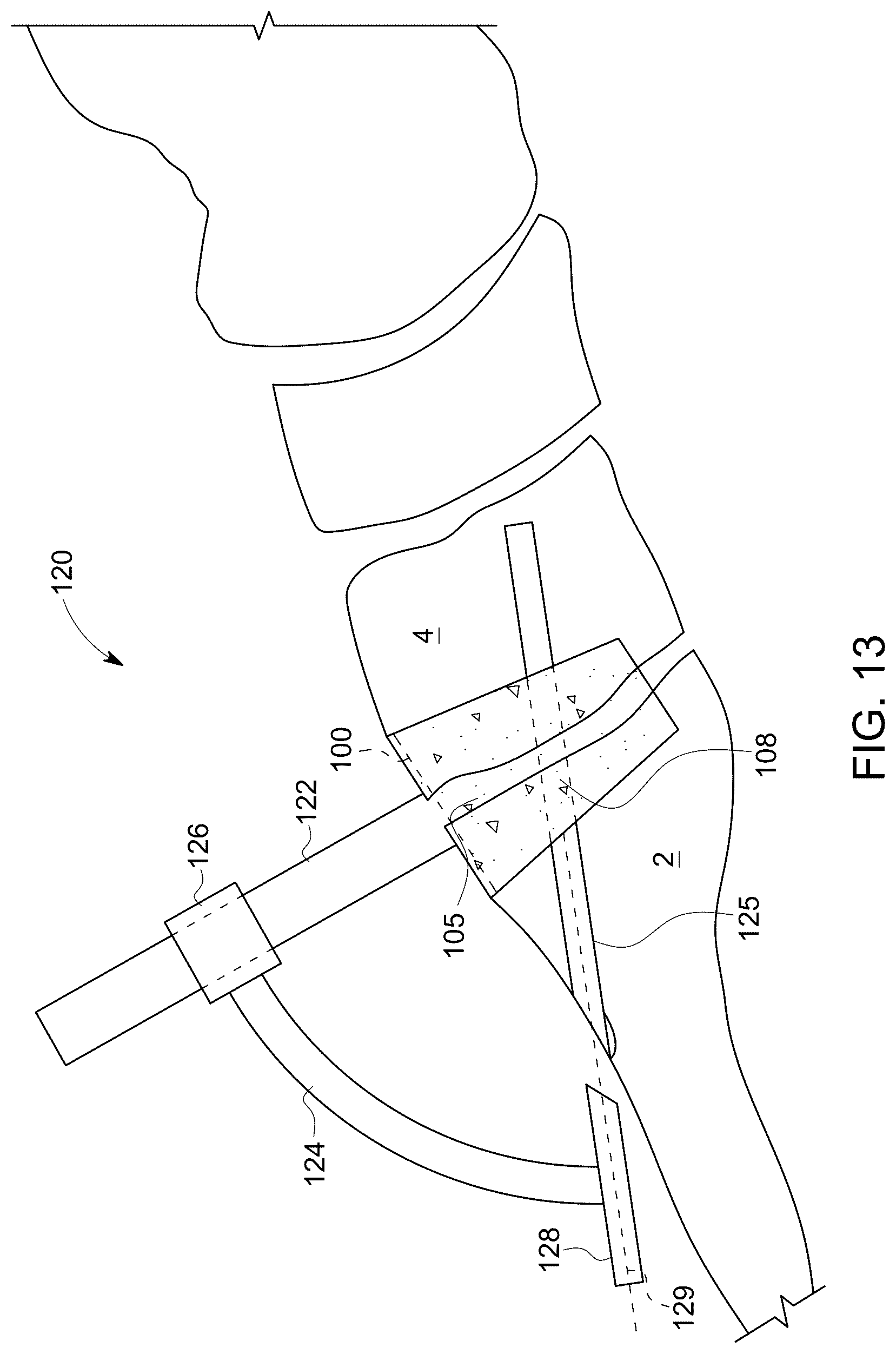 Patent US12496198 Figure 7 – Dowel guide instrument and method for treating mid-foot disorders
