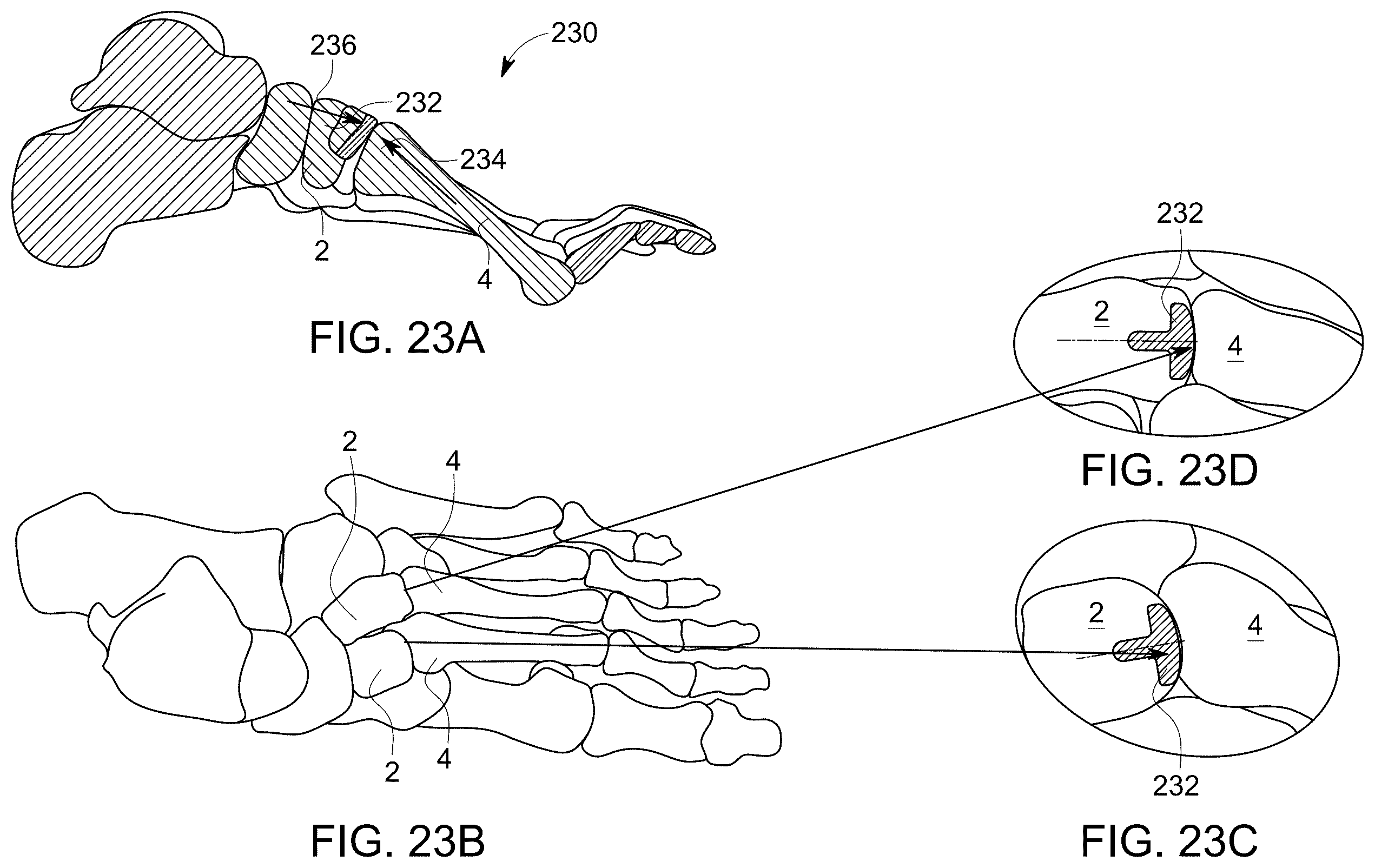 Patent US12496198 Figure 14 – Dowel guide instrument and method for treating mid-foot disorders
