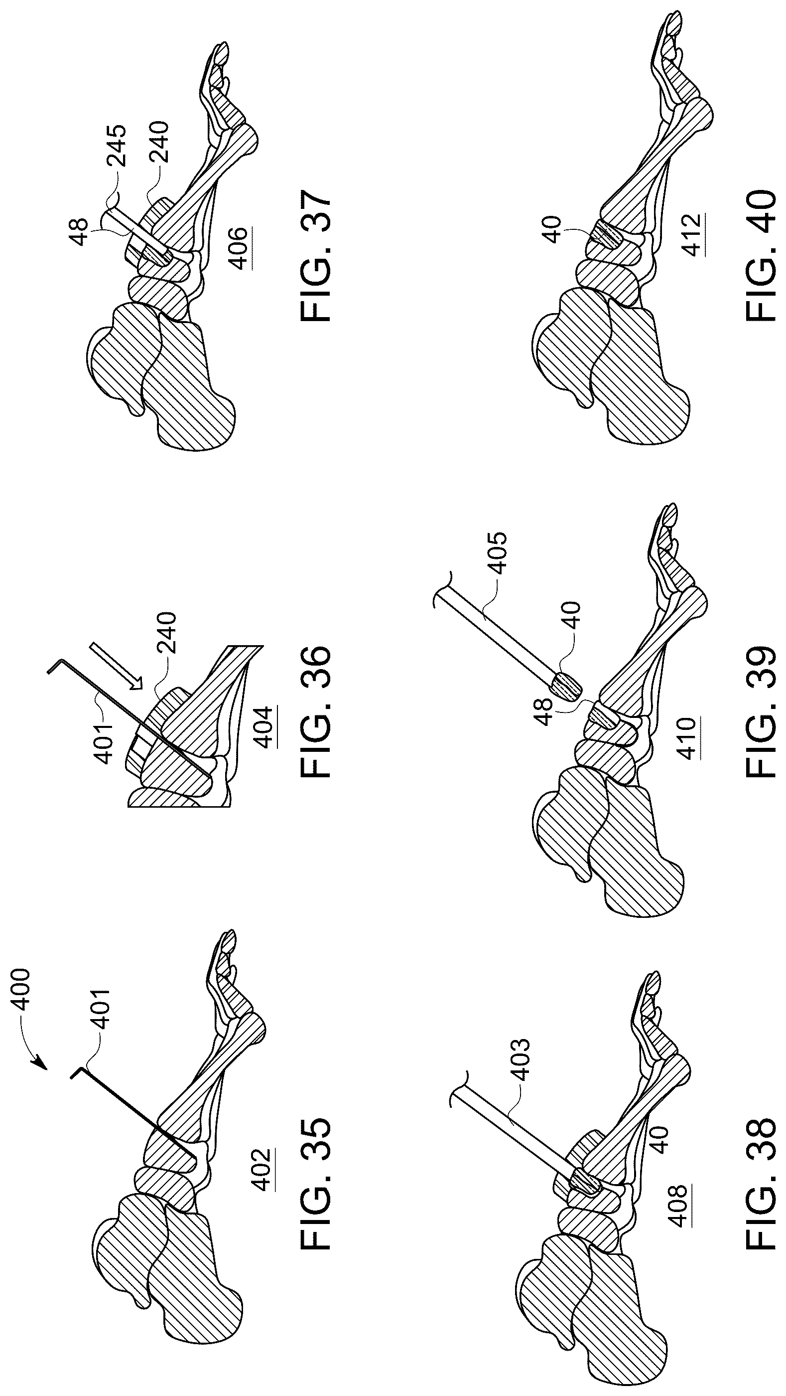 Patent US12496198 Figure 17 – Dowel guide instrument and method for treating mid-foot disorders