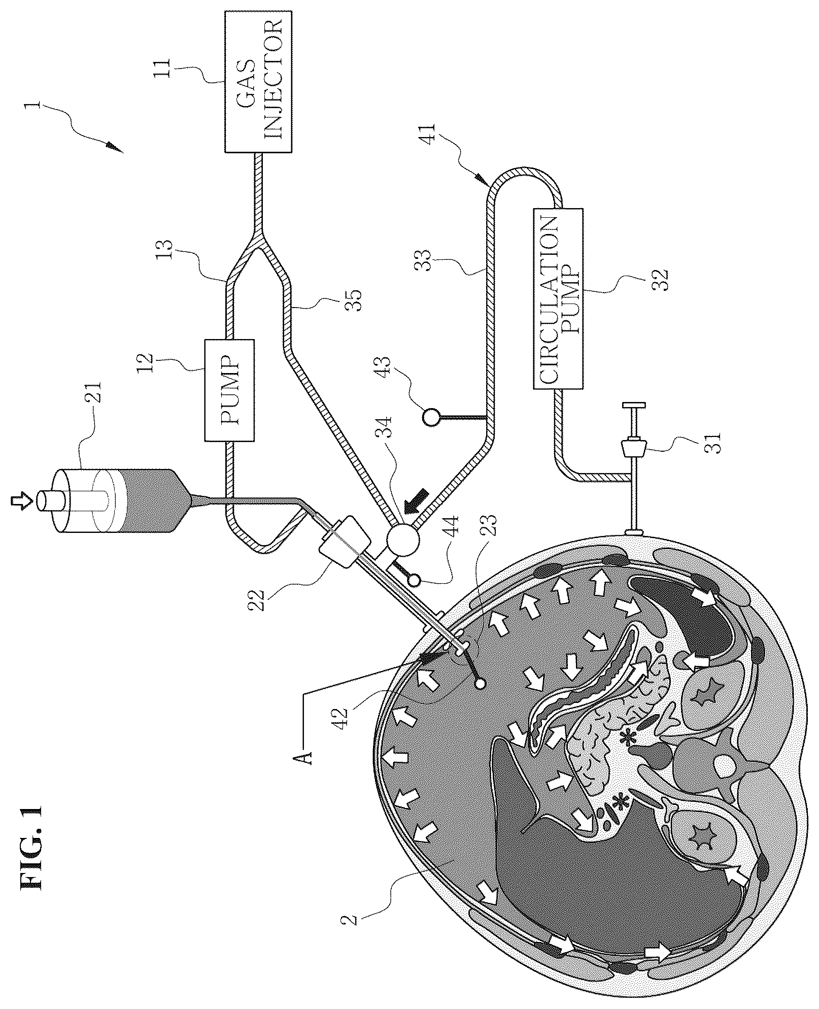 Patent US12496217 — System for circulating hyperthermic pressurized gas in peritoneal cavity, and intraperitoneal gas providing system including two-fluid nozzle — Figure 1