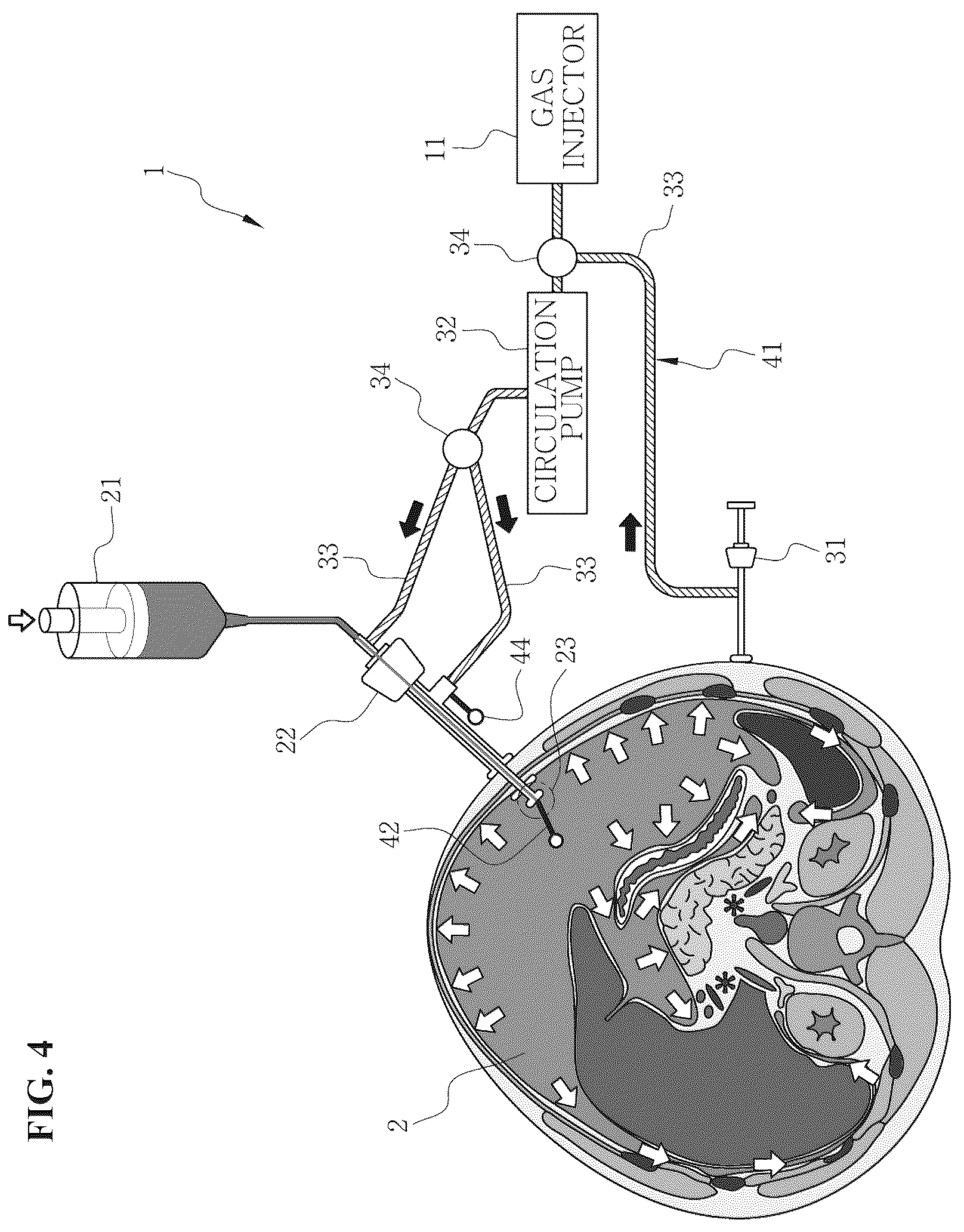 Patent US12496217 Figure 4 – System for circulating hyperthermic pressurized gas in peritoneal cavity, and intraperitoneal gas providing system including two-fluid nozzle