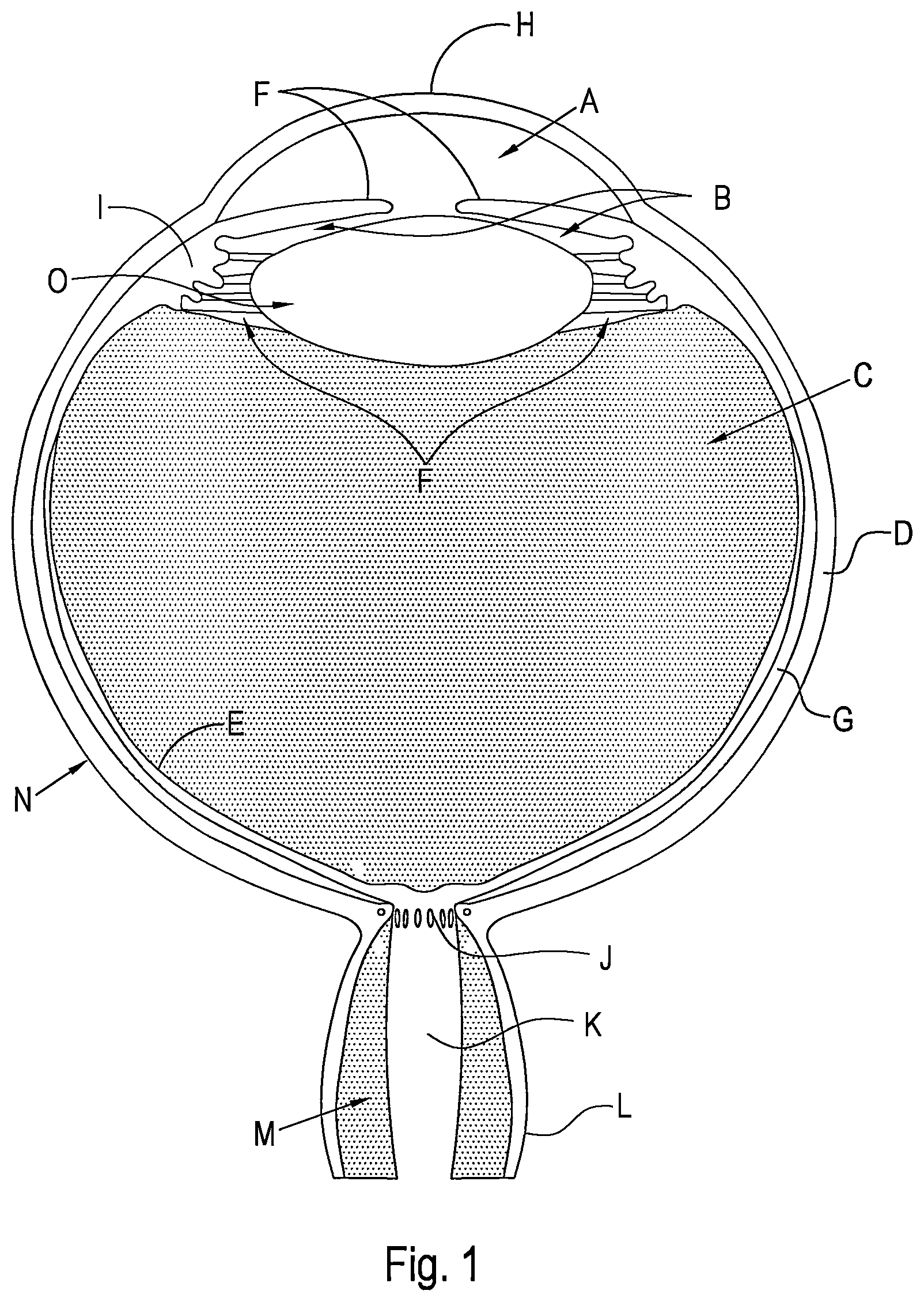 Patent US12496221 — Shunt and method for treating glaucoma — Figure 1