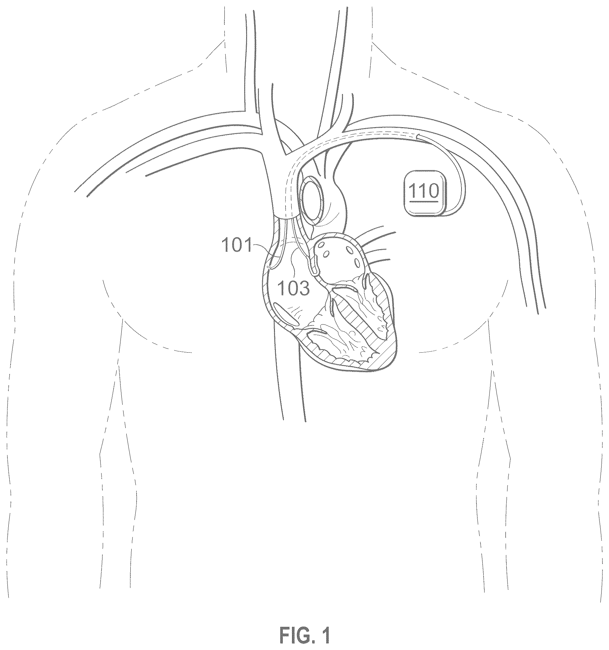 Patent US12496441 — Implantable endovascular, low profile intracardiac left atrial restraining devices for low energy atrial cardioversion, pacing and sensing — Figure 1