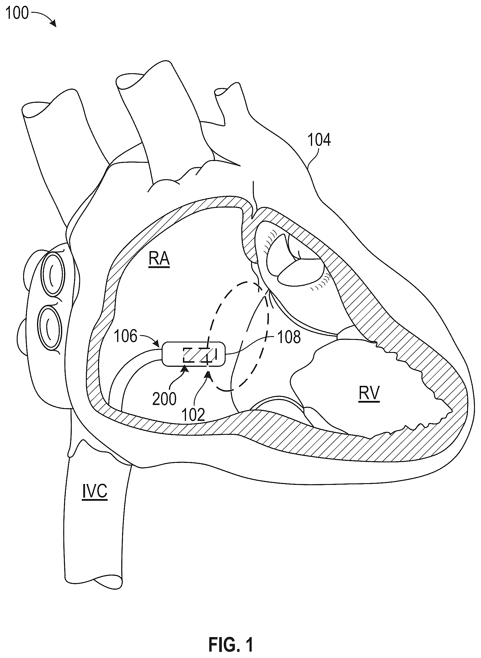 Patent US12496452 Figure 1 – Multi-electrode implantable medical device (IMD)