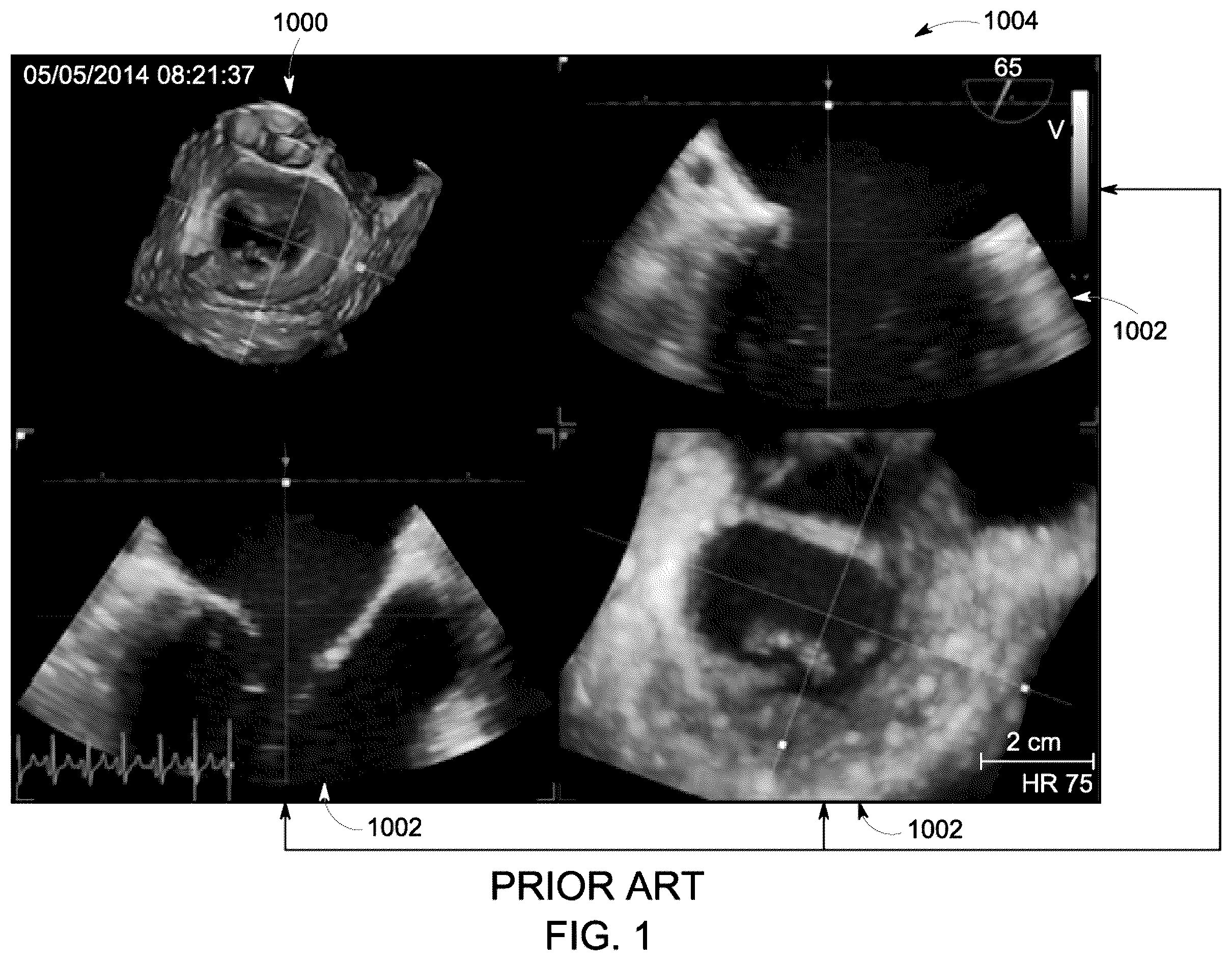 Patent US12504535 — System and method for anatomically aligned multi-planar reconstruction views for ultrasound imaging using a geometrical model — Figure 1
