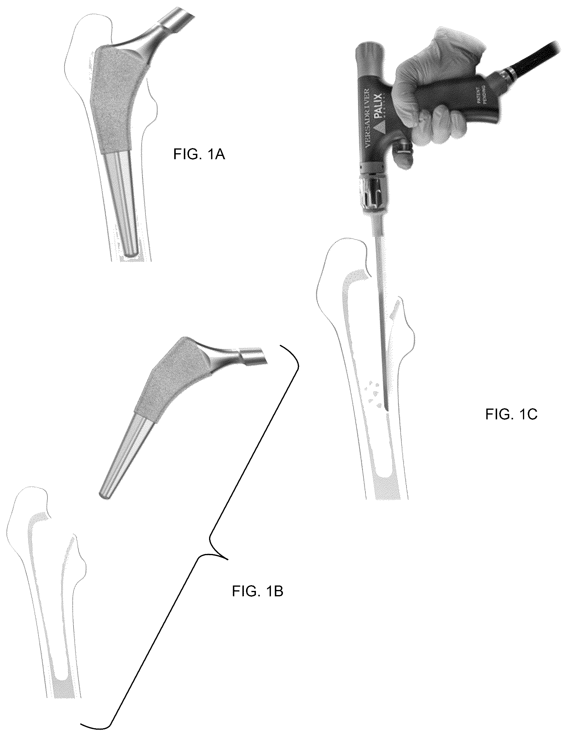 Patent US12508035 — Scoring blade and method for bone cement removal from intramedullary canal — Figure 1