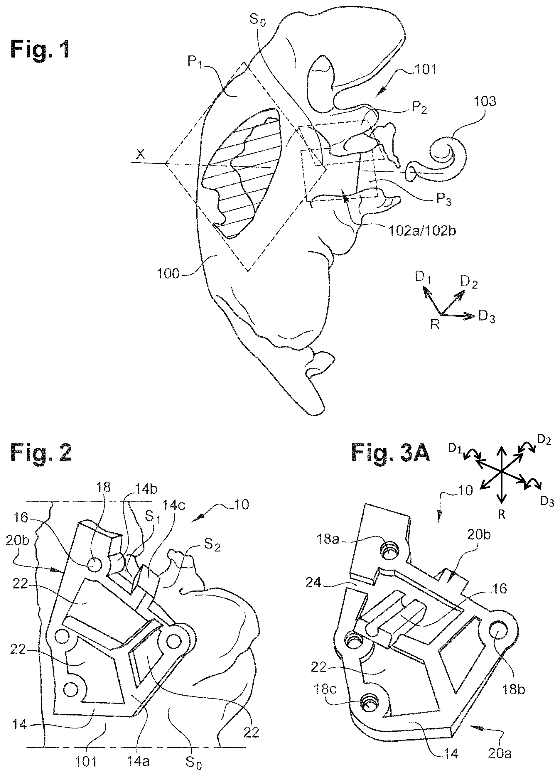 Patent US12508038 — Surgical insertion guide — Figure 1