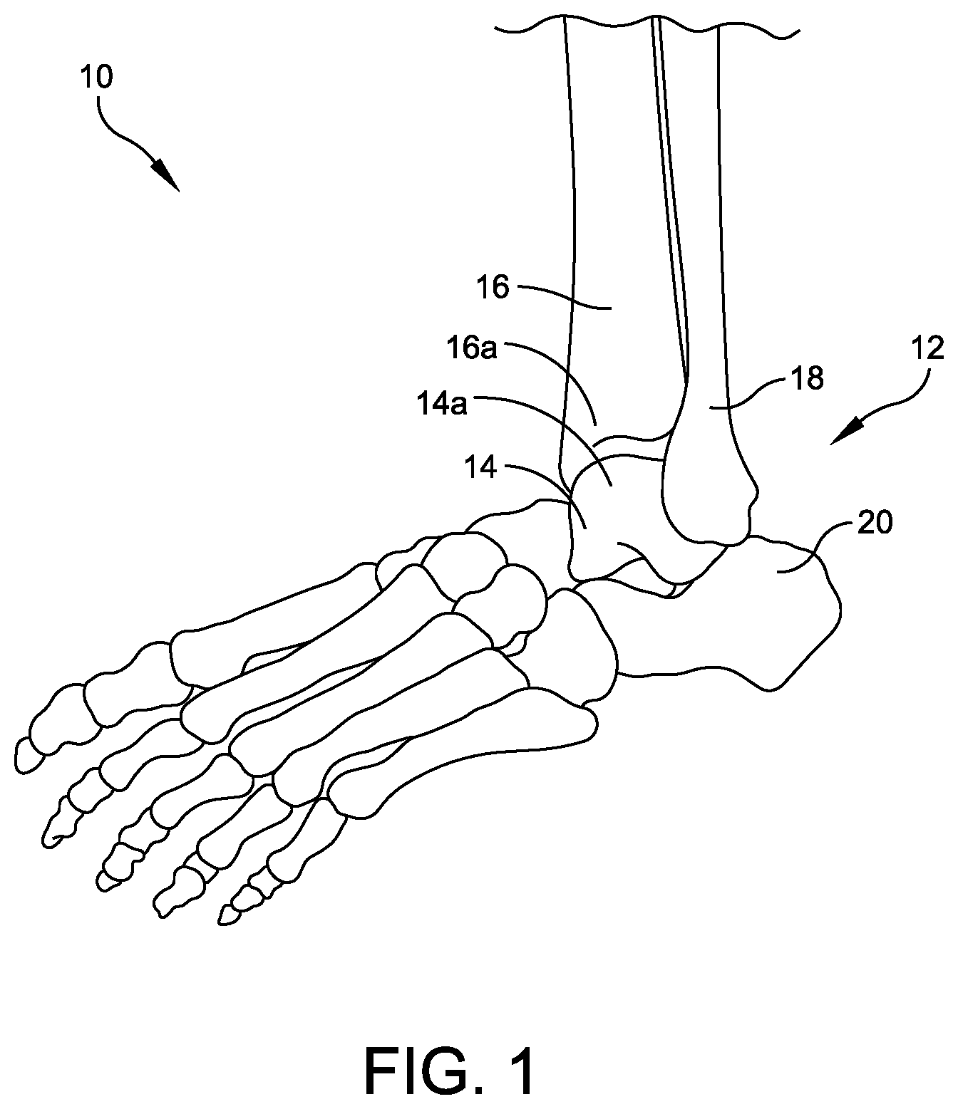 Patent US12508039 — Orthopedic surgical guide — Figure 1