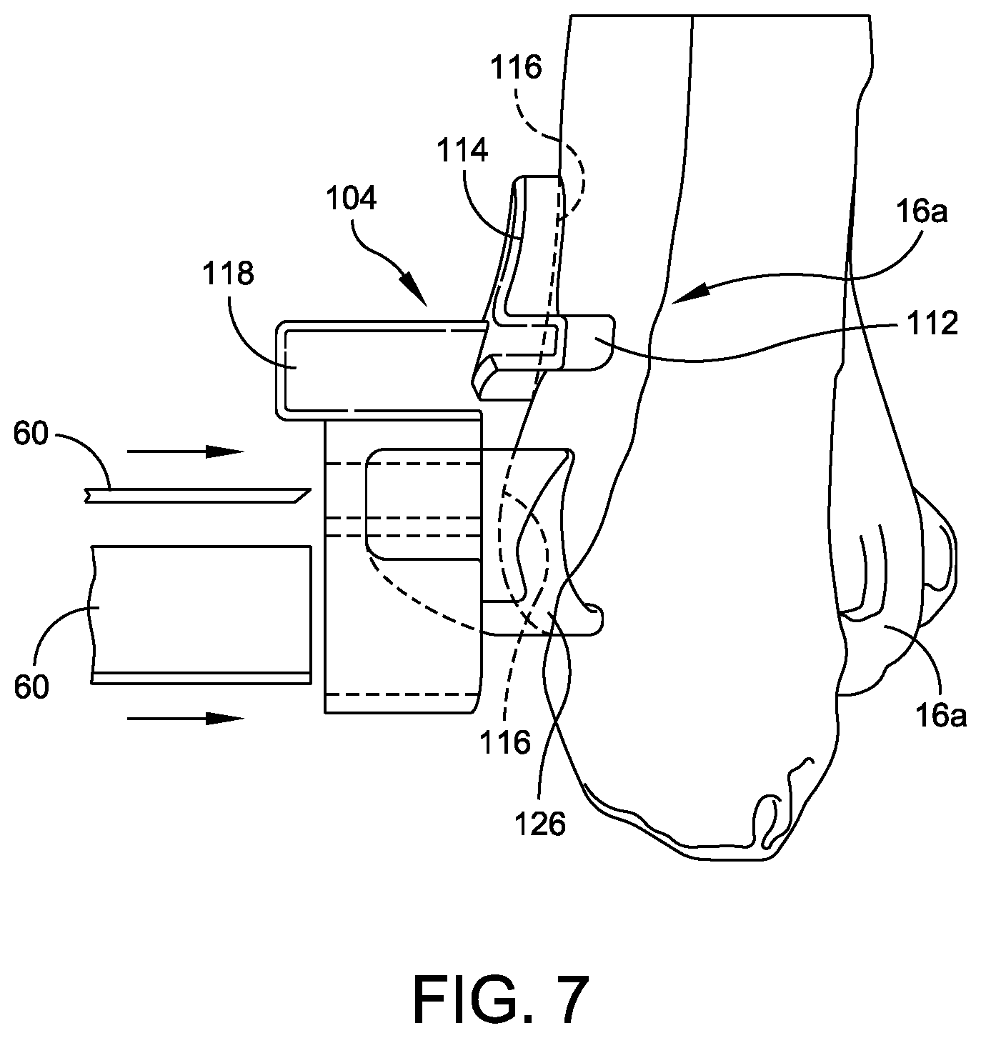 Patent US12508039 Figure 7 – Orthopedic surgical guide