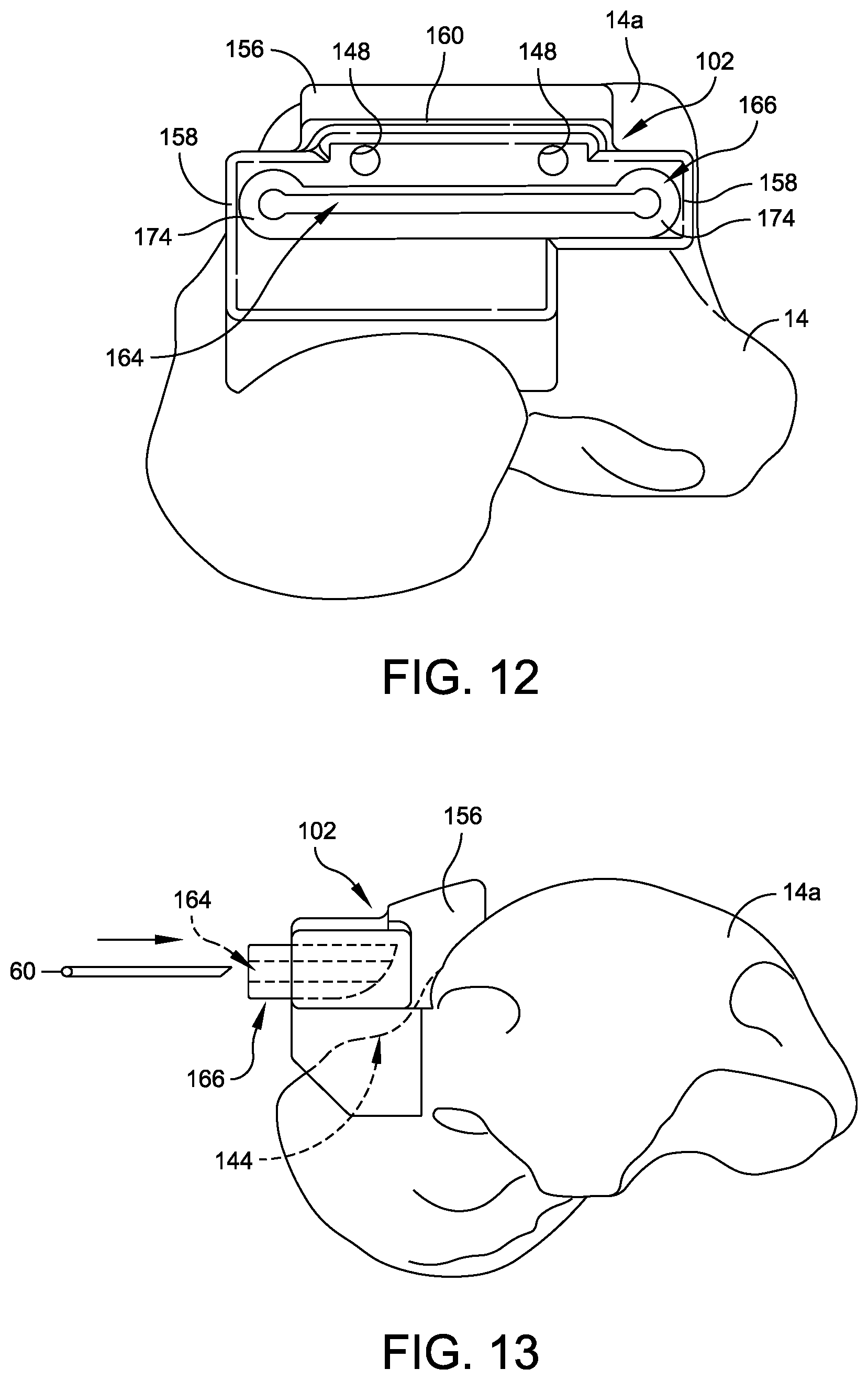 Patent US12508039 Figure 11 – Orthopedic surgical guide