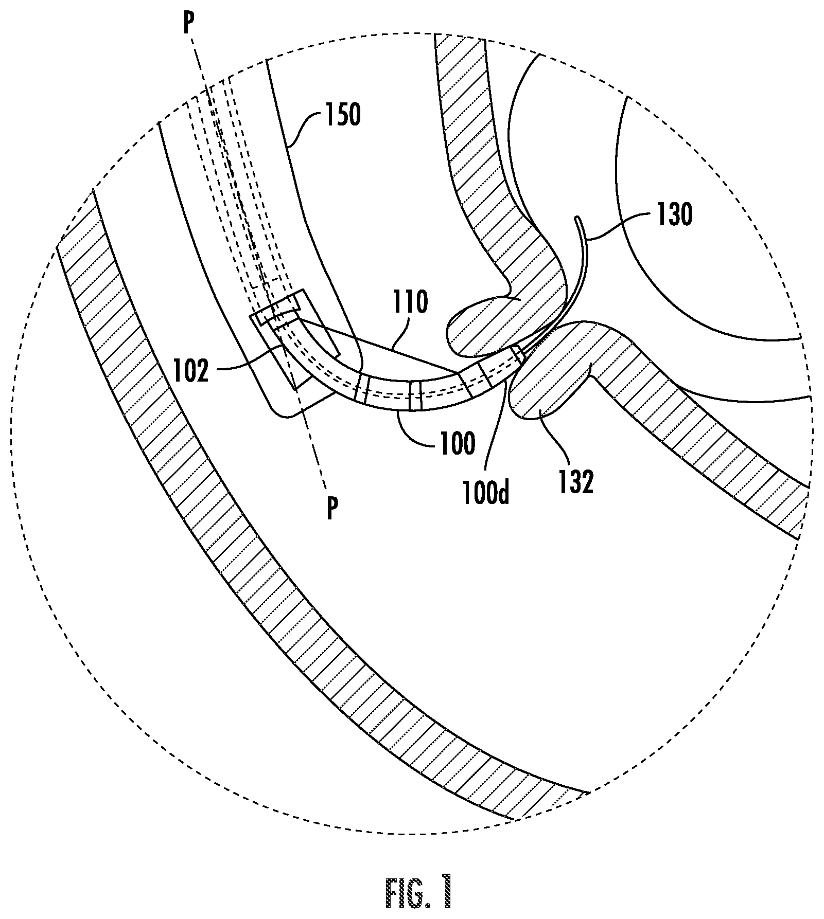 Patent US12508047 Figure 1 – Devices, systems, and methods for accessing a body lumen