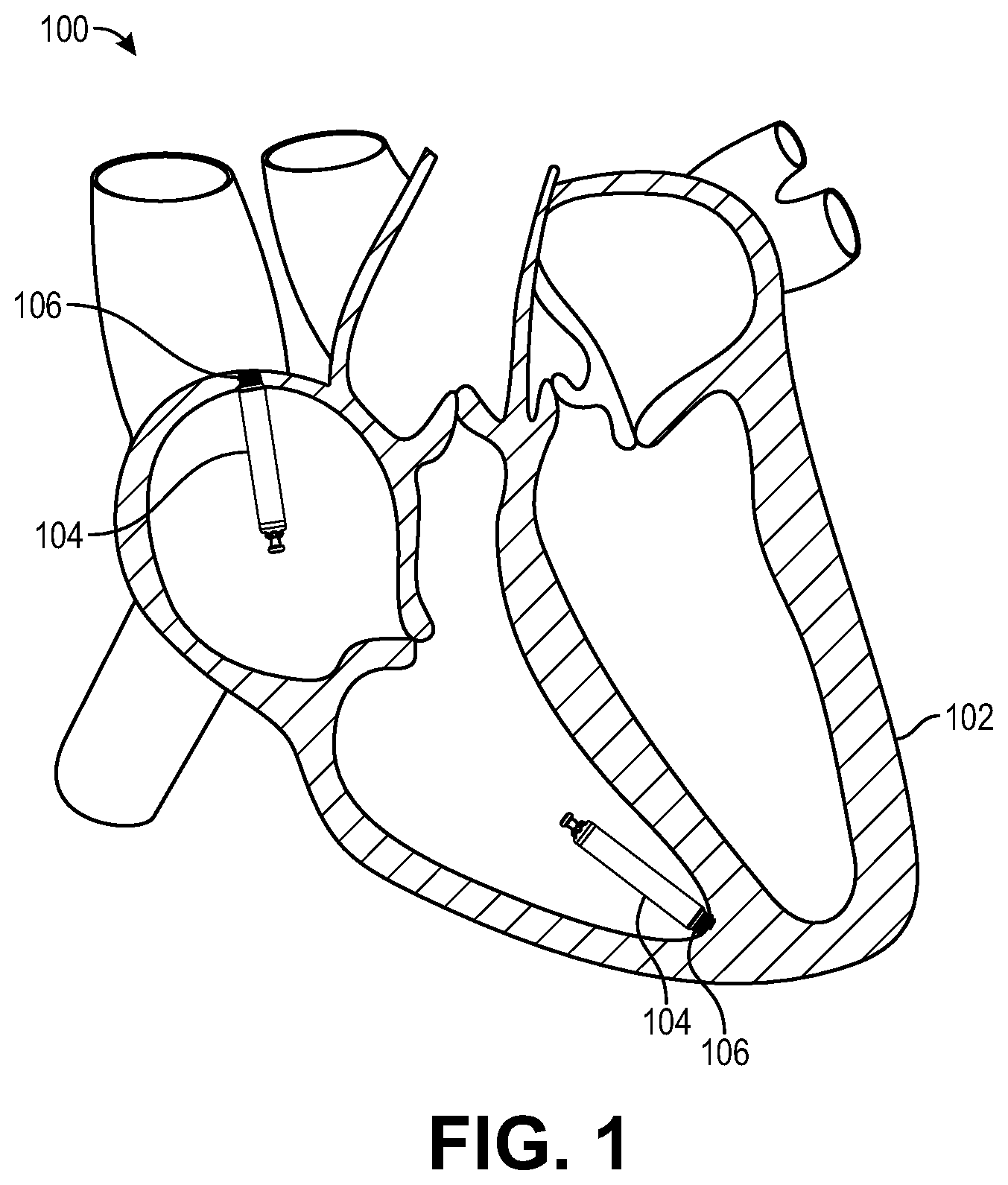 Patent US12508052 — Implant delivery and retrieval systems and methods — Figure 1