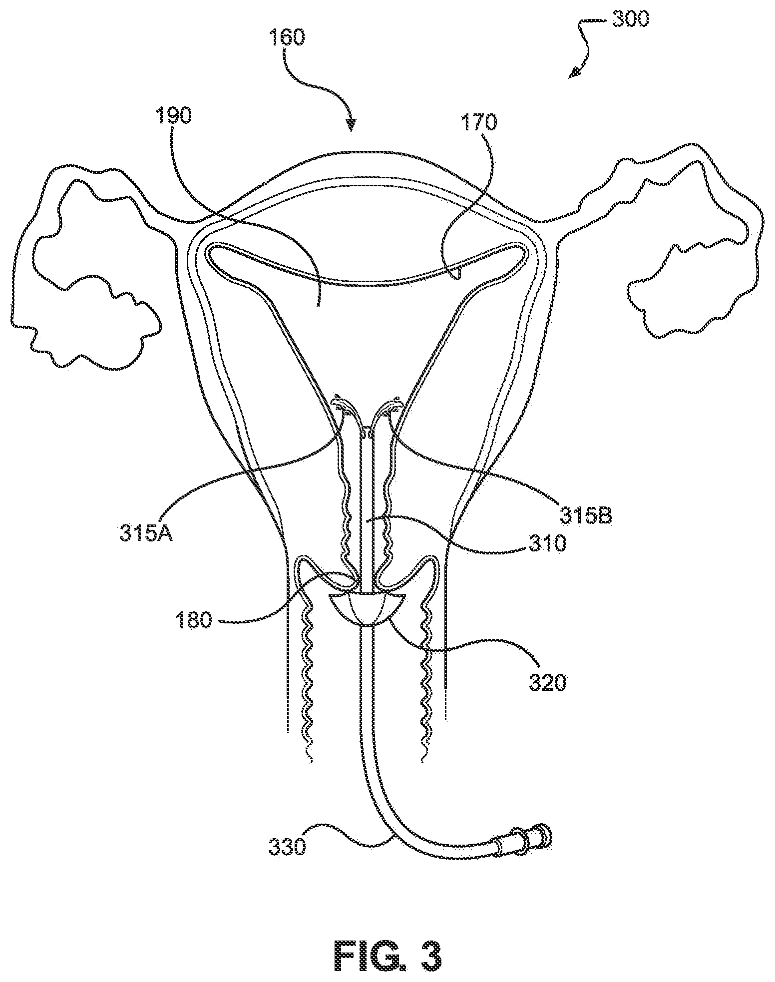 Patent US12508053 Figure 3 – Systems, devices, and methods for uterine hemostasis