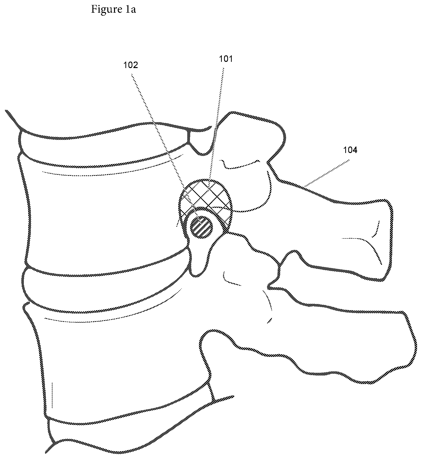 Patent US12508090 — Synchronized robotic bone milling — Figure 1