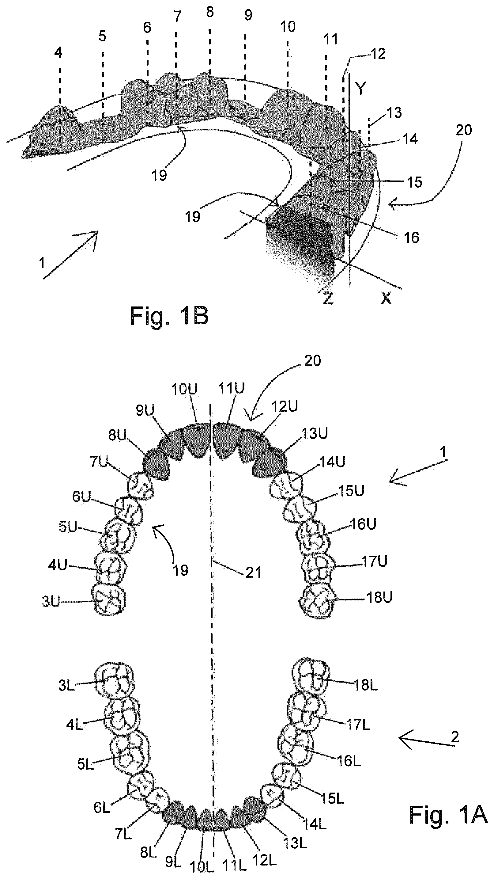 Patent US12508113 Figure 1 – Method of manufacturing a pressure chamber of a dental mouthpiece, method of manufacturing a dental mouthpiece, pressure chamber and mouthpiece manufactured with these methods, provided with these methods, J-/U-shaped dental mouthpiece, and systems comprising said mouthpieces