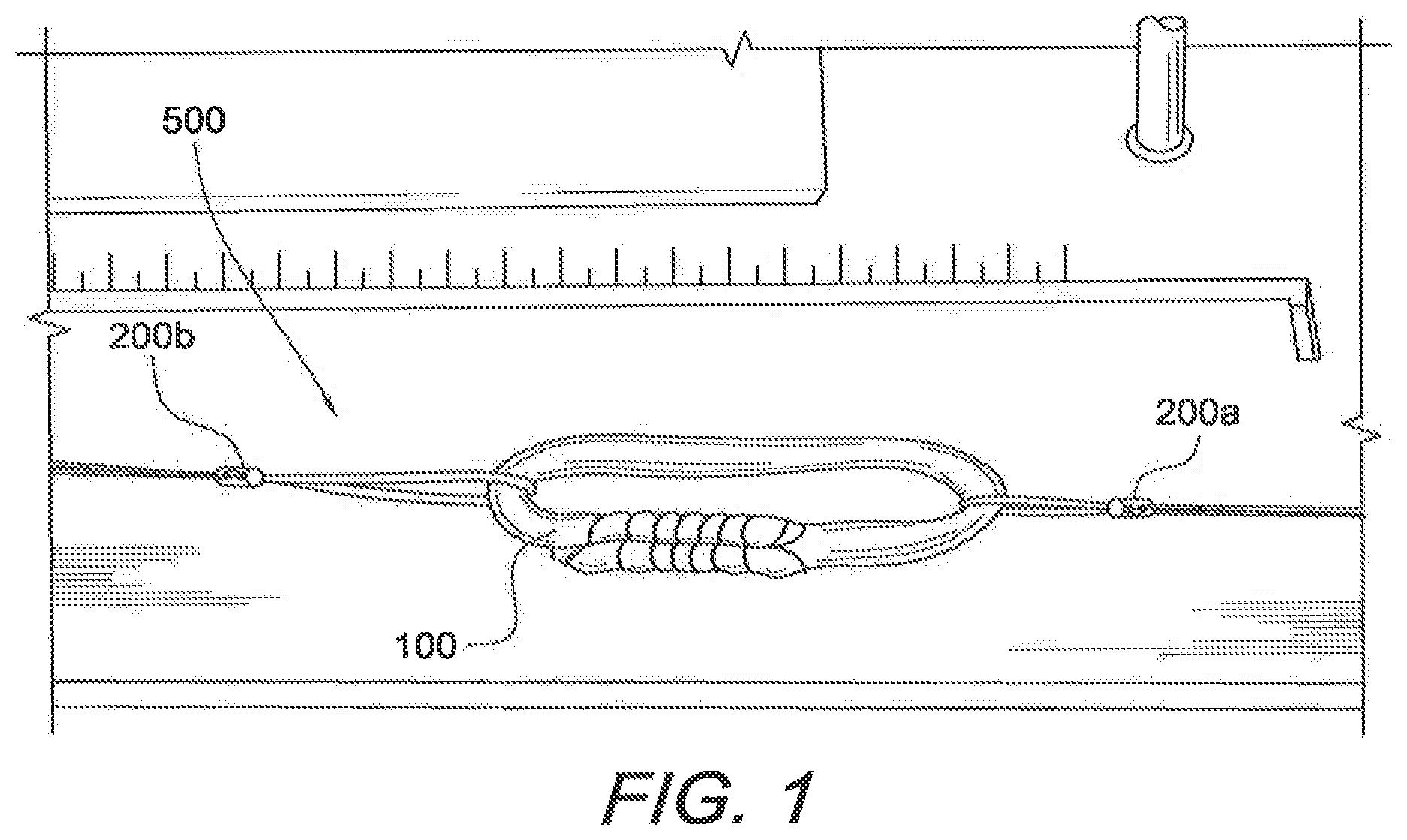 Patent US12508121 Figure 1 – Reinforced biological construct and method of reinforcing biological construct