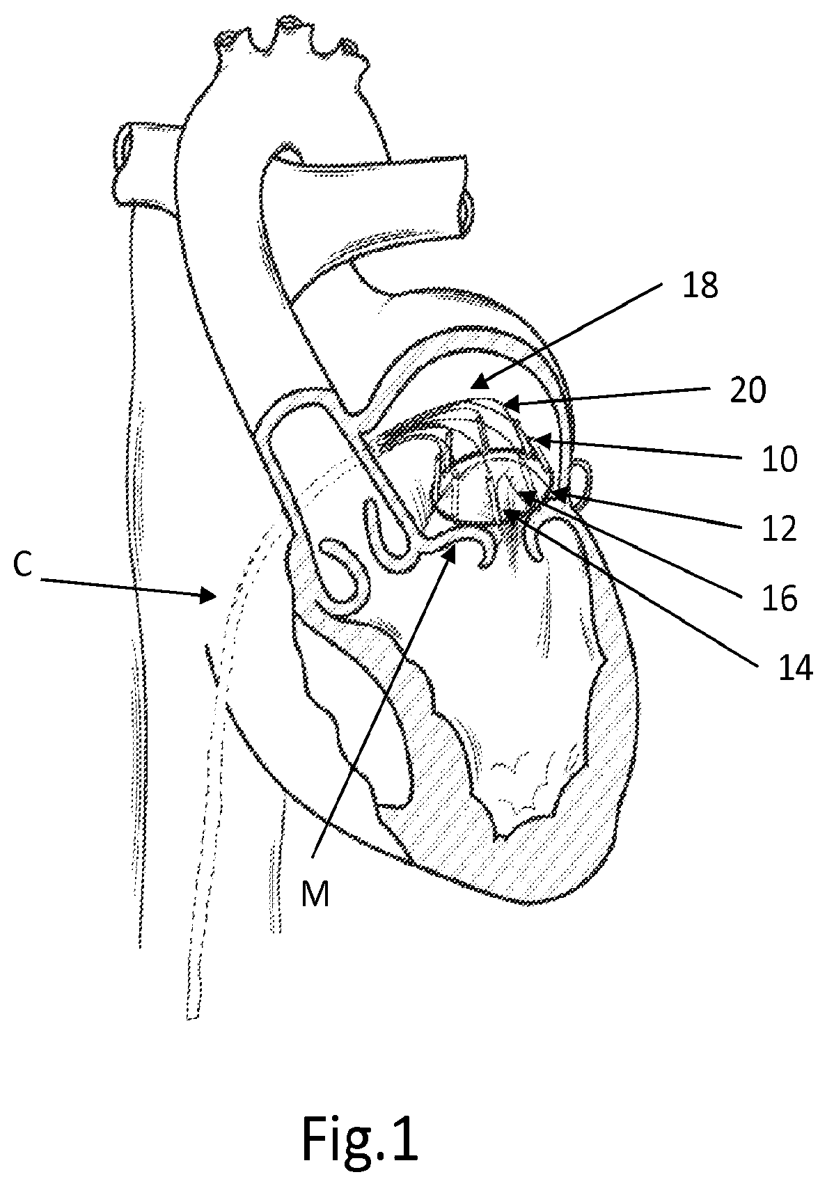 Patent US12508129 — Cardiac valve replacement — Figure 1