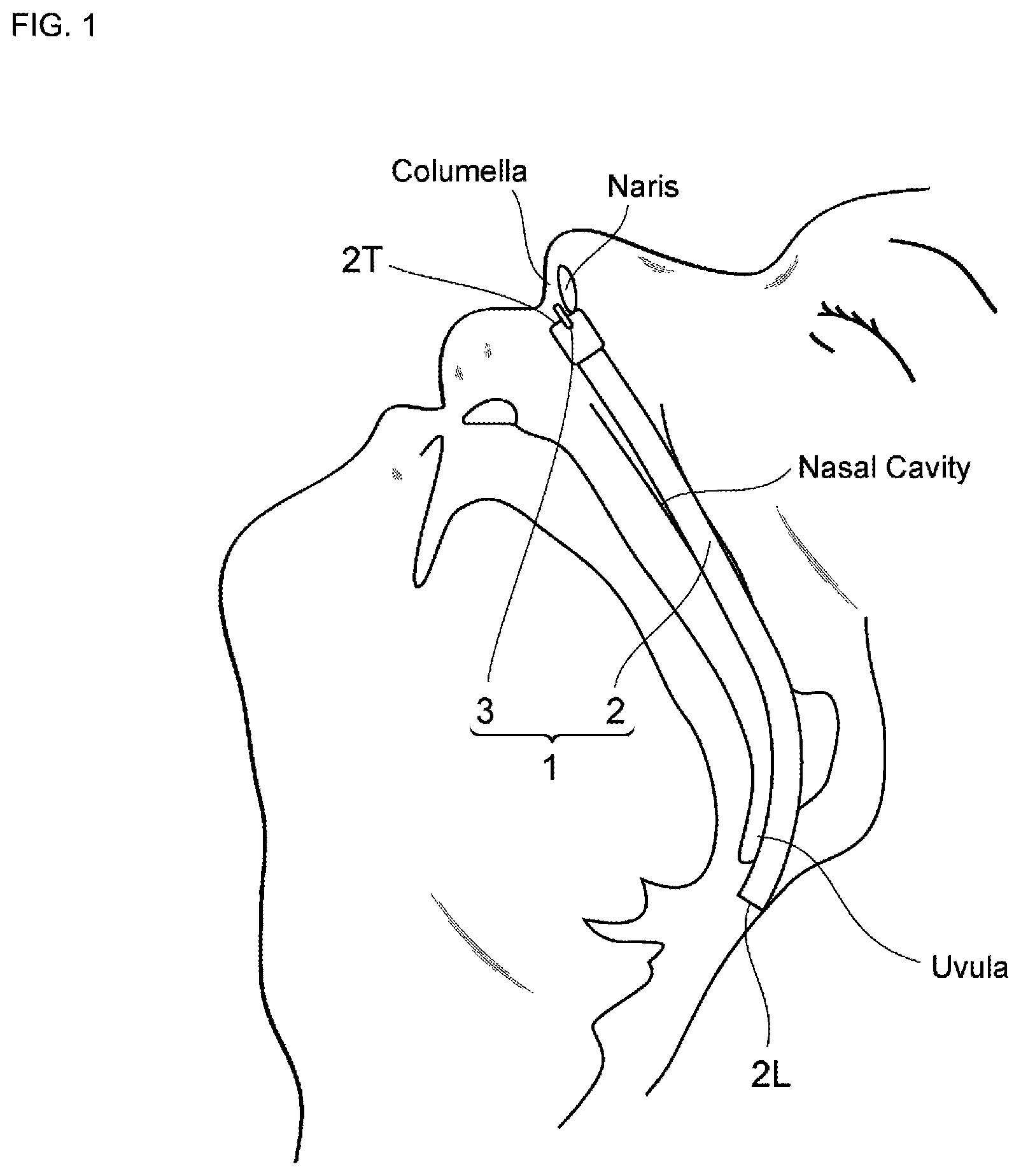 Patent US12508149 — Nasal cavity insertion device — Figure 1