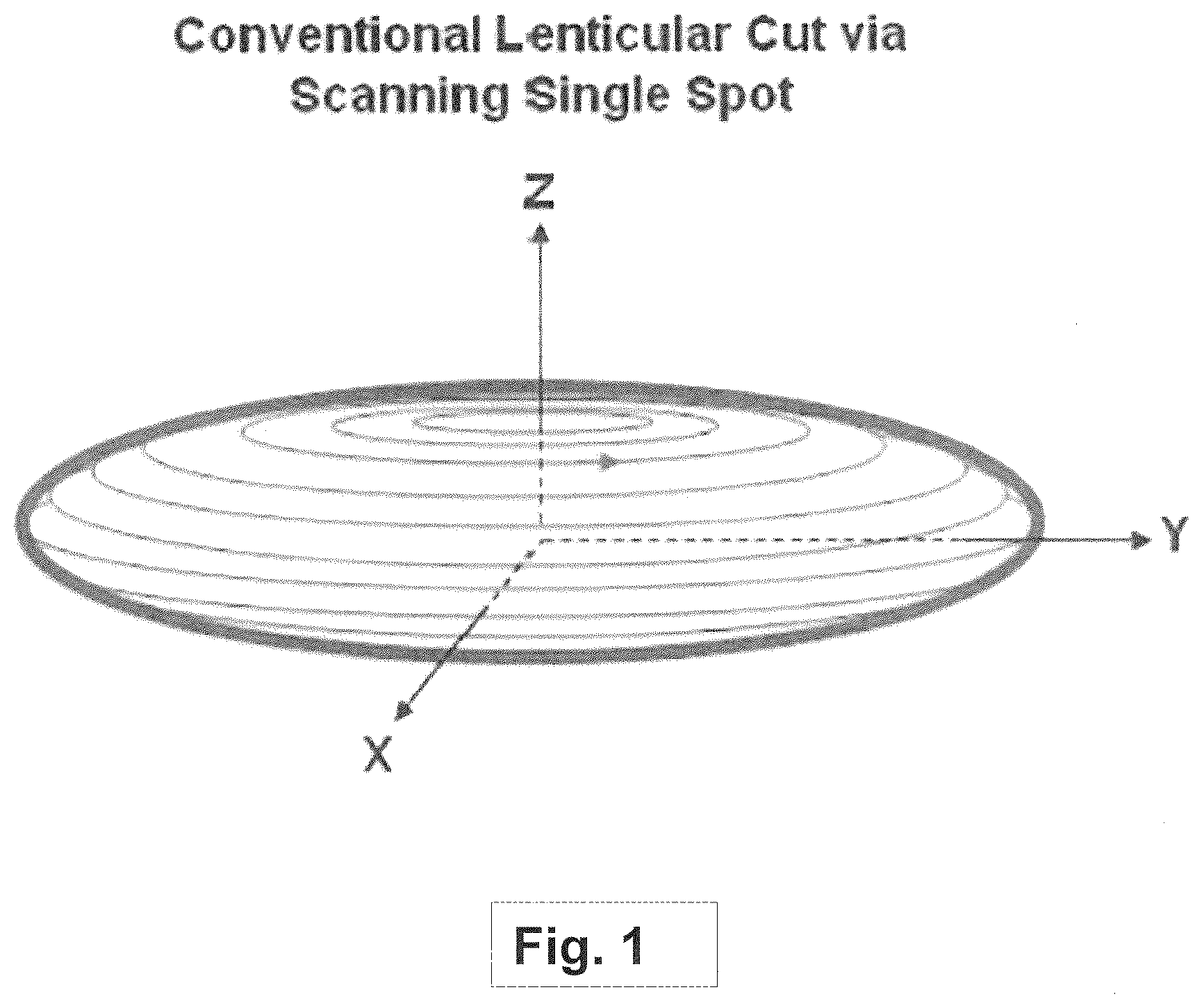 Patent US12508163 Figure 1 – Systems and methods for lenticular laser incision