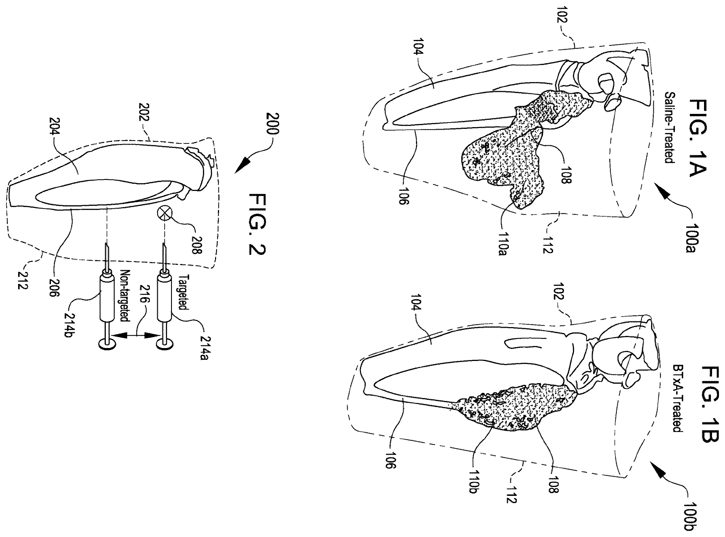 Patent US12508374 Figure 1 – Systems for inhibiting heterotopic ossification