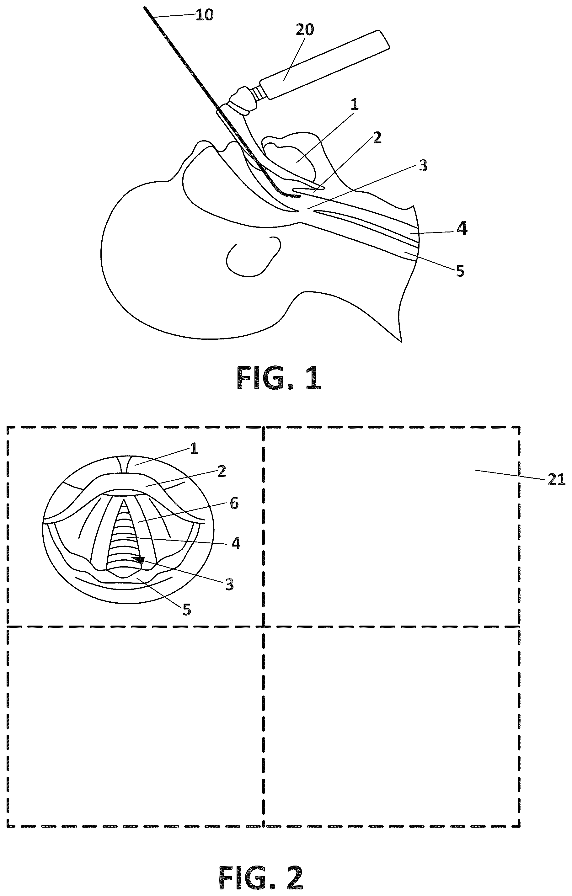 Patent US12508380 Figure 1 – Intubation bougie