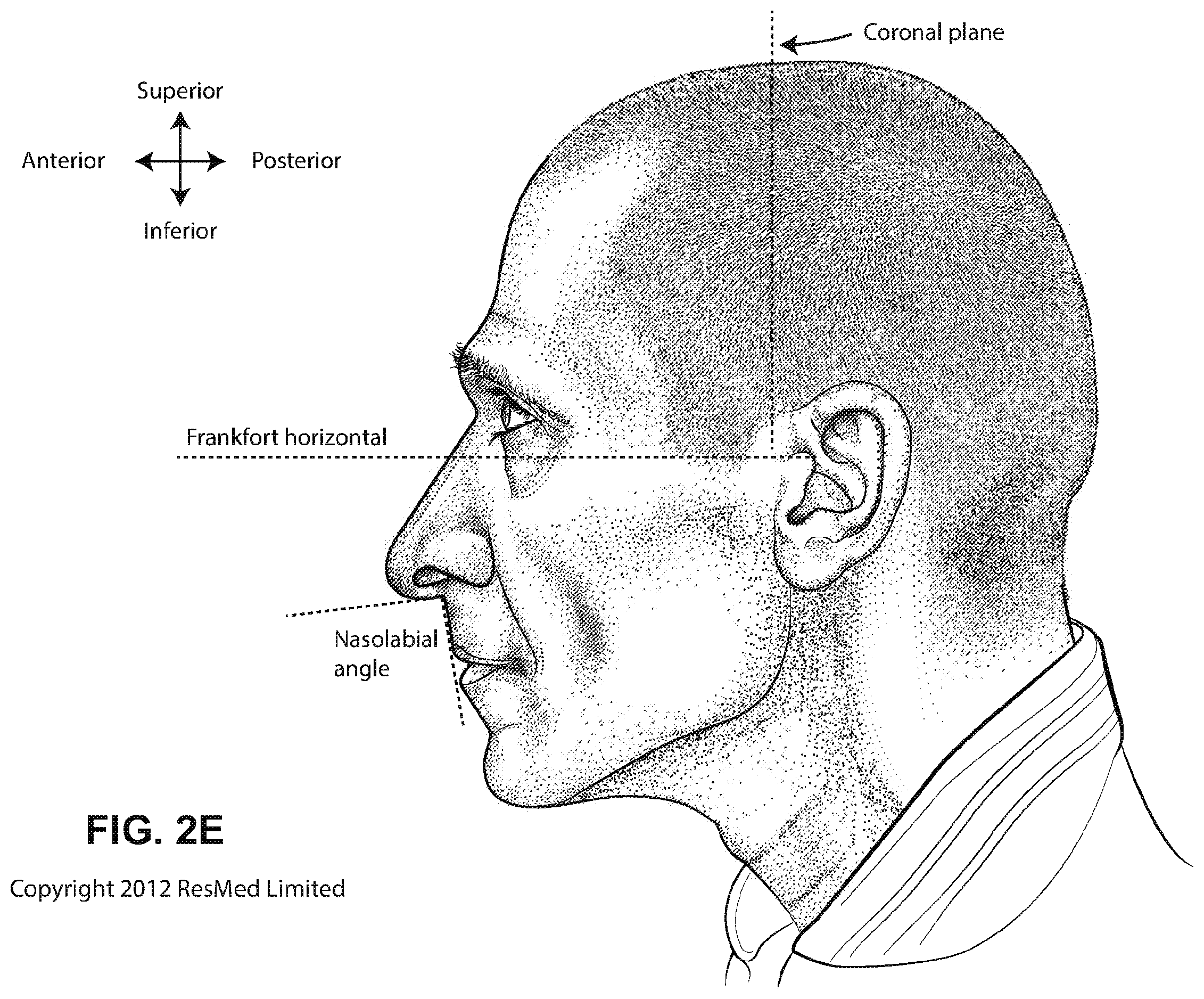 Patent US12508384 Figure 8 – Cushion module for a patient interface