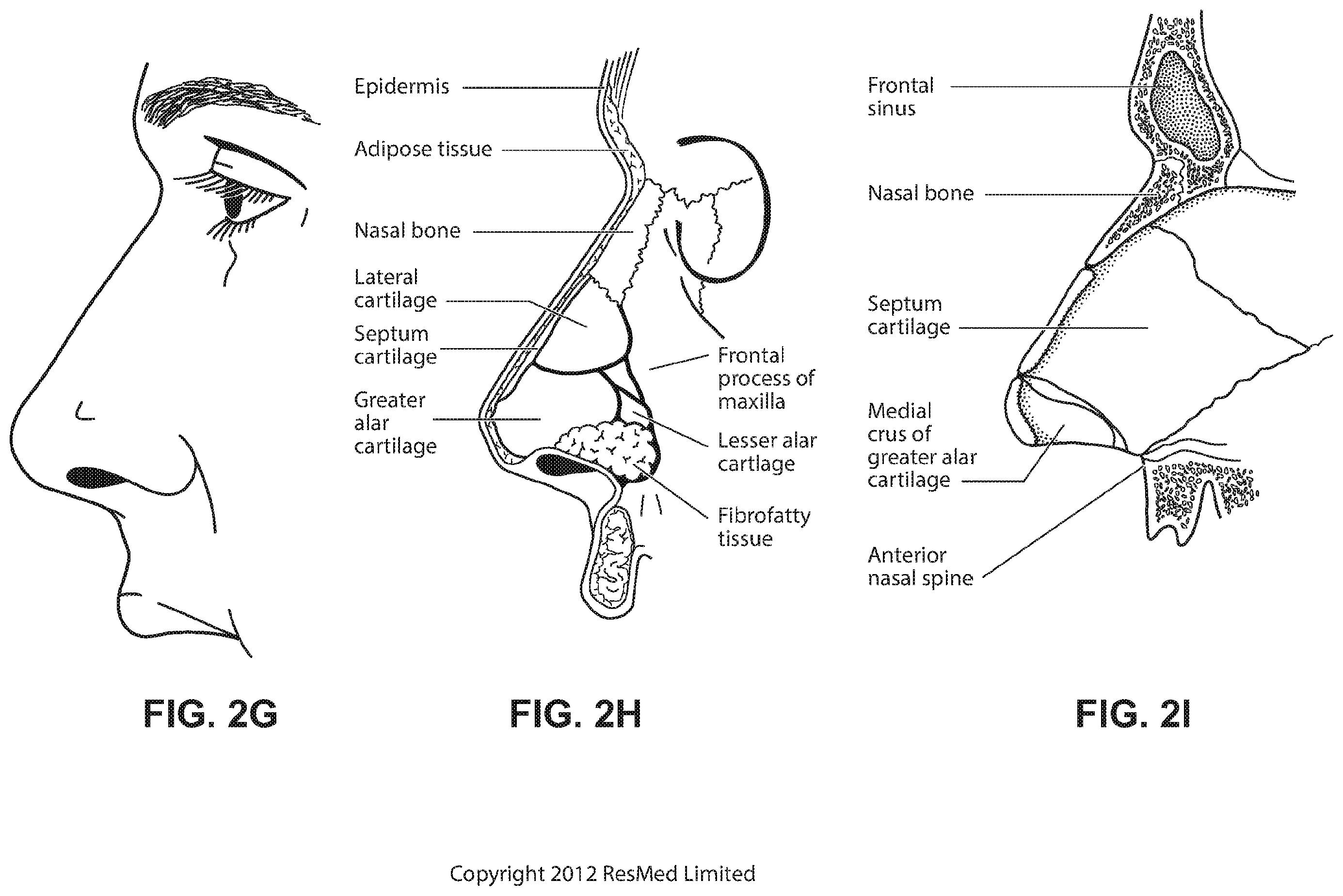 Patent US12508384 Figure 10 – Cushion module for a patient interface