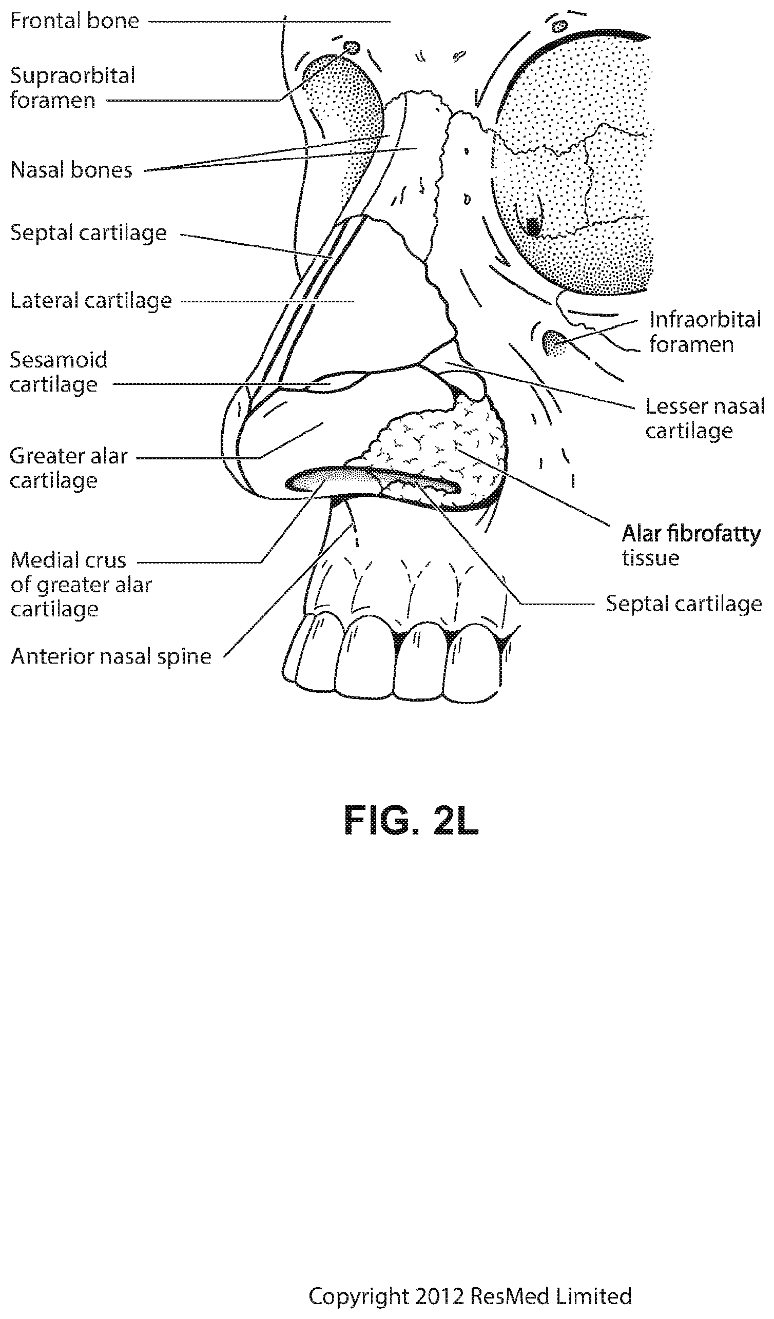 Patent US12508384 Figure 12 – Cushion module for a patient interface