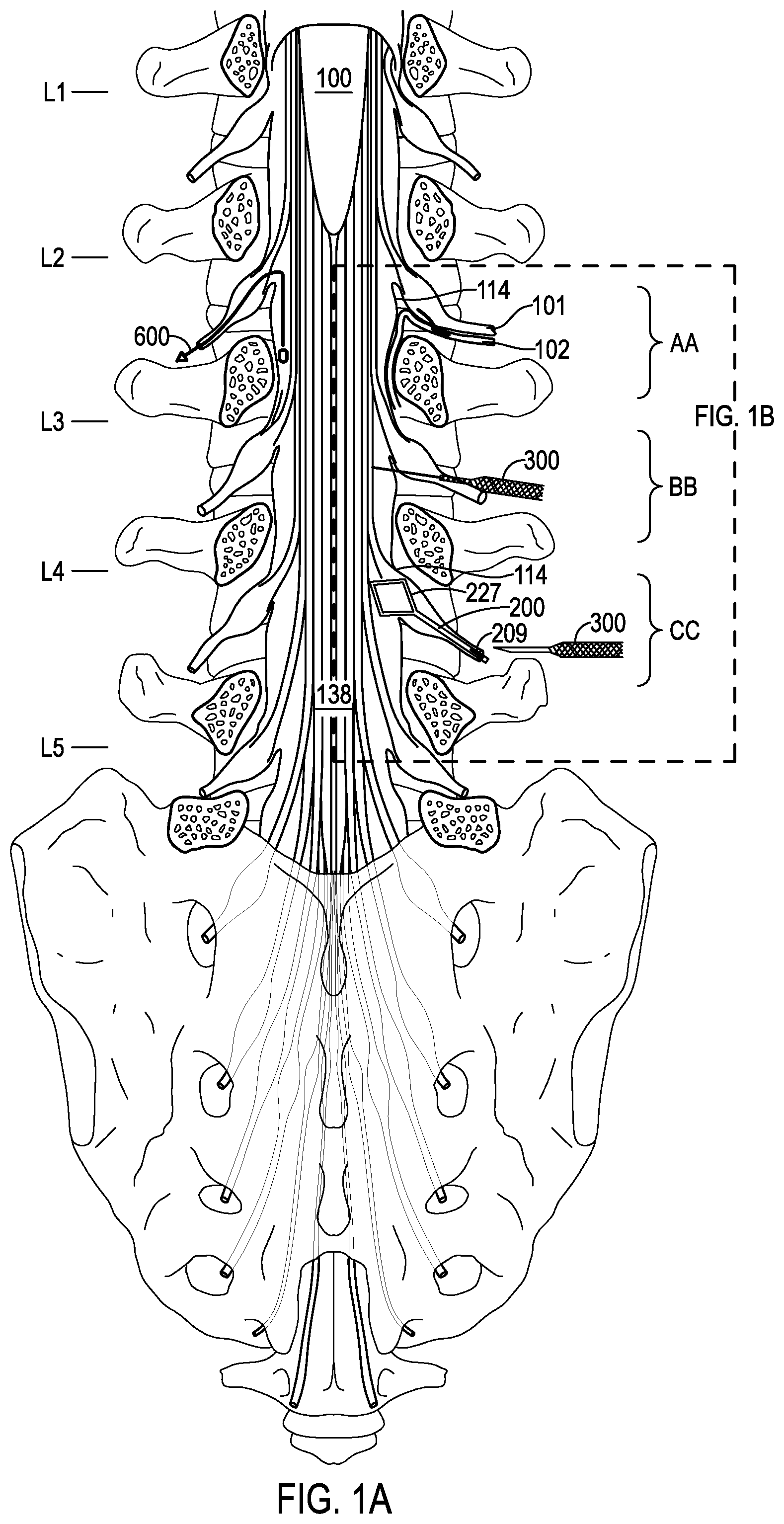 Patent US12508406 — Systems and methods for treating hydrocephalus — Figure 1