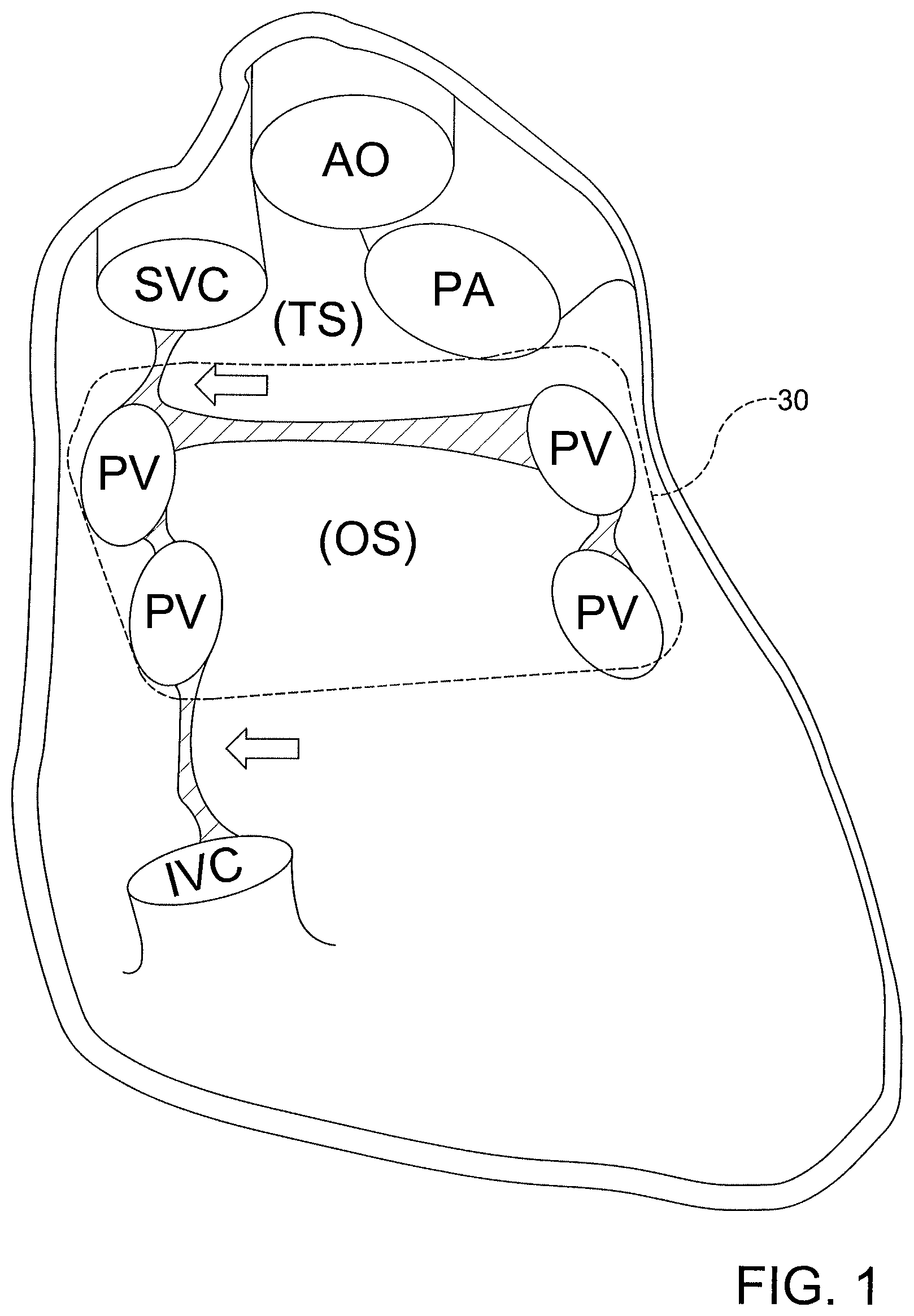 Patent US12508411 — Catheters, catheter systems, and methods for ablating a tissue region — Figure 1