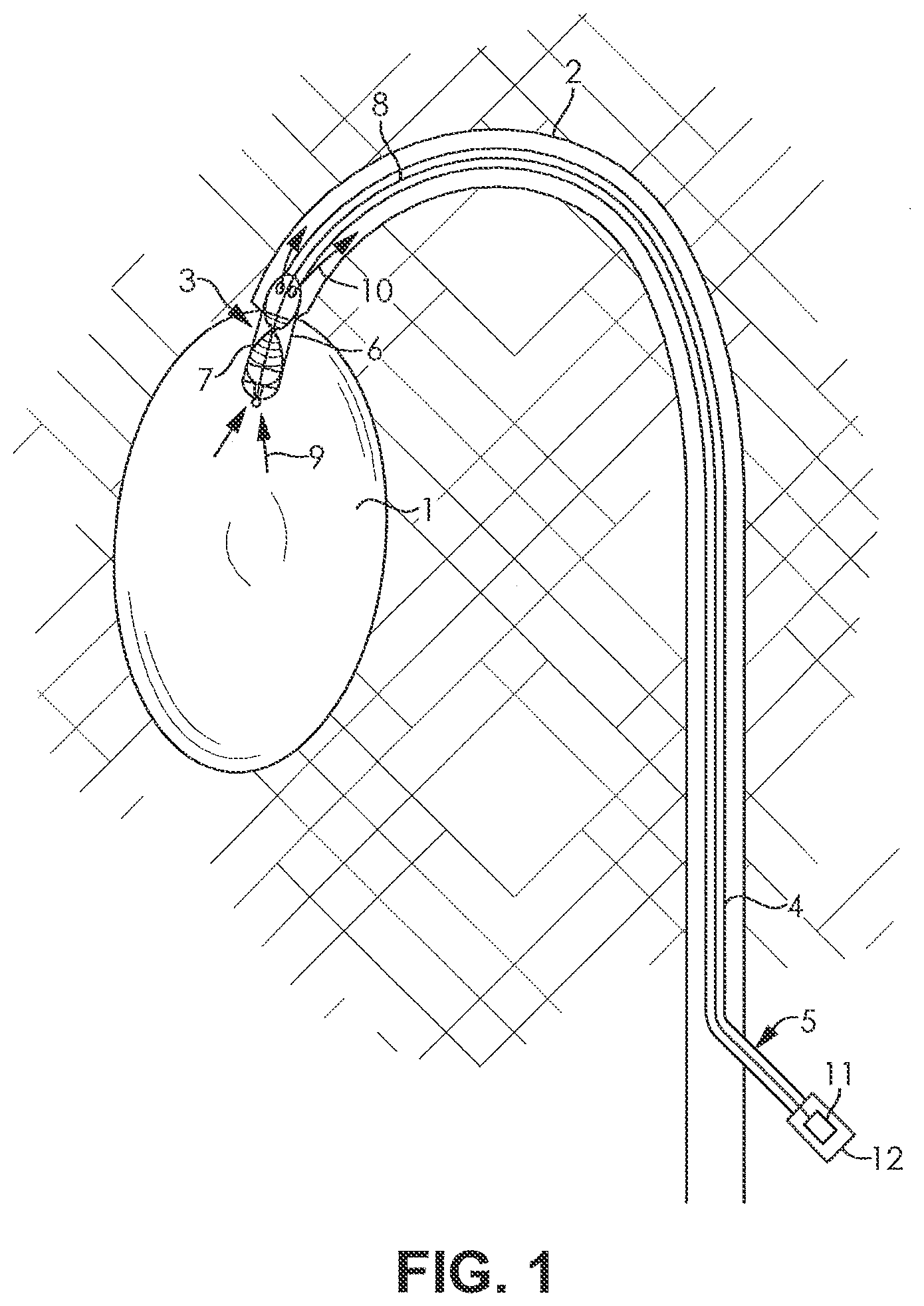 Patent US12508417 — Fluid pump changeable in diameter, in particular for medical application — Figure 1