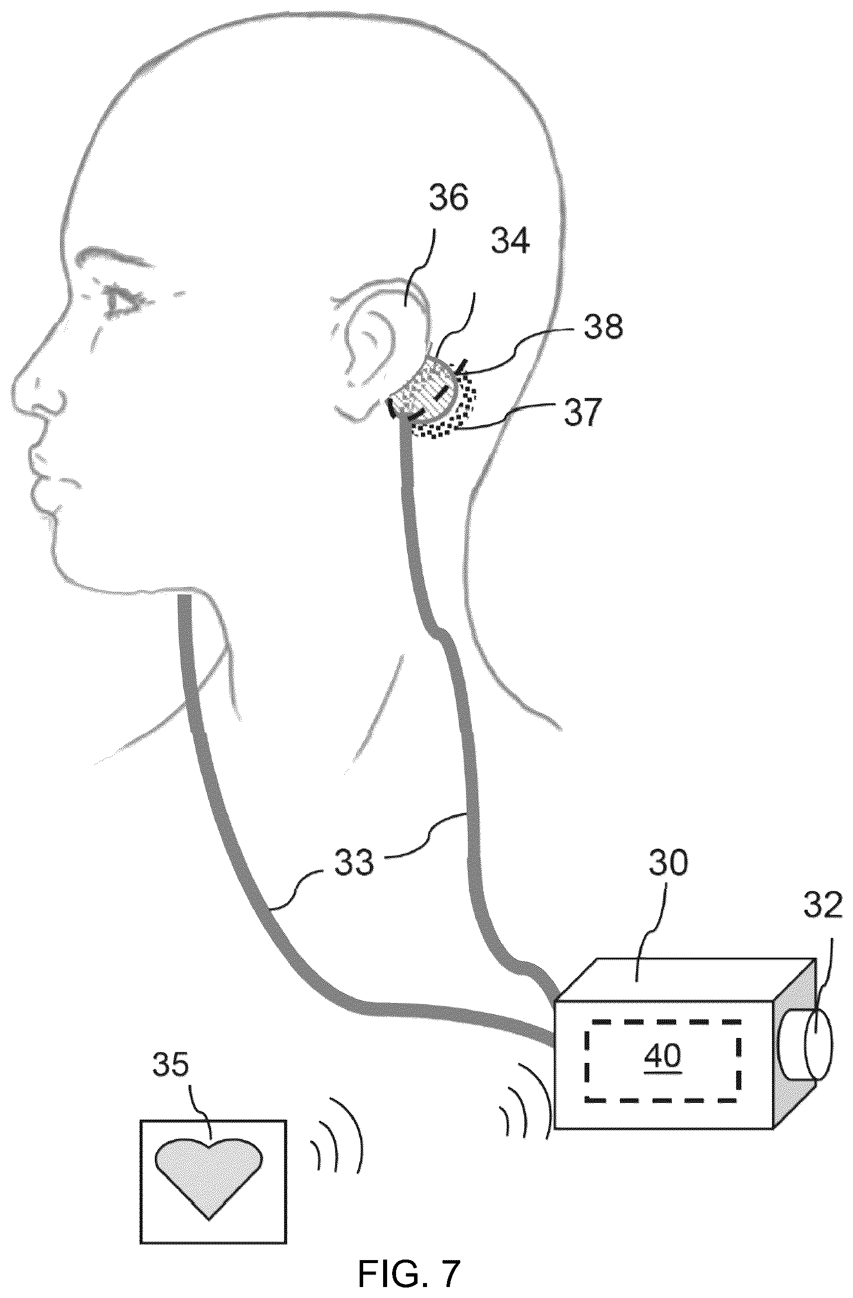 Patent US12508419 Figure 6 – Systems, devices and methods for treating post-infection symptoms of COVID-19 using vestibular nerve stimulation