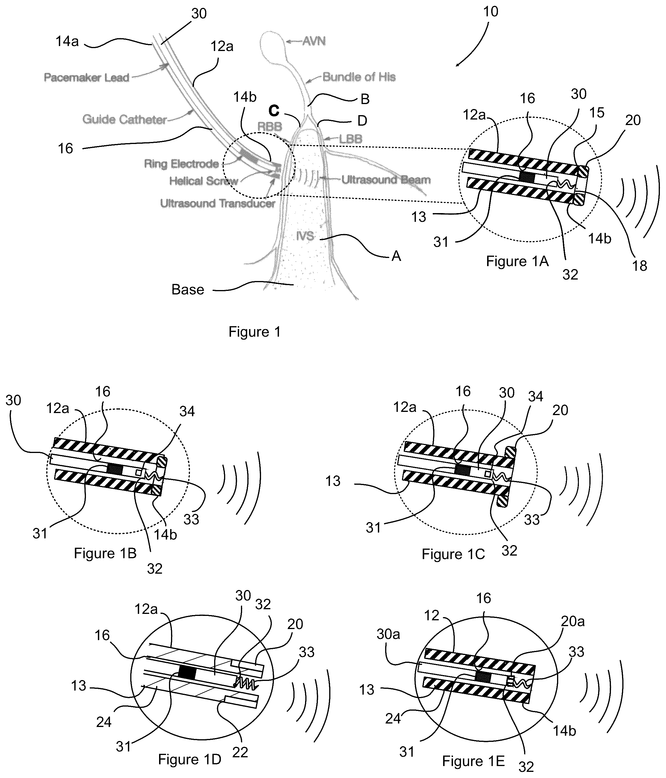 Patent US12508422 — Ultrasound guidance assembly and system — Figure 1