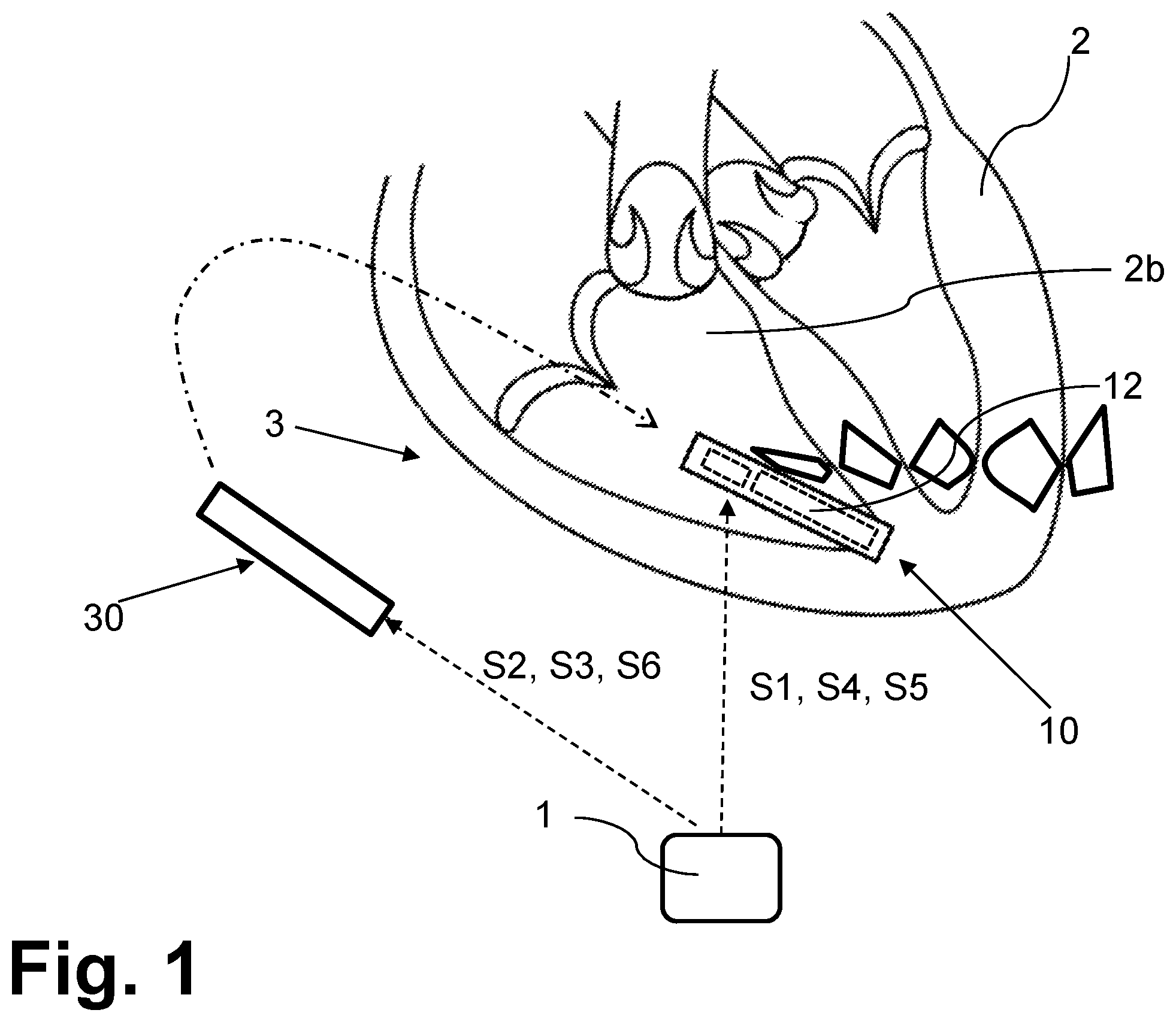 Patent US12508432 — Configurable replacement mechanism for leadless pacemaker system — Figure 1