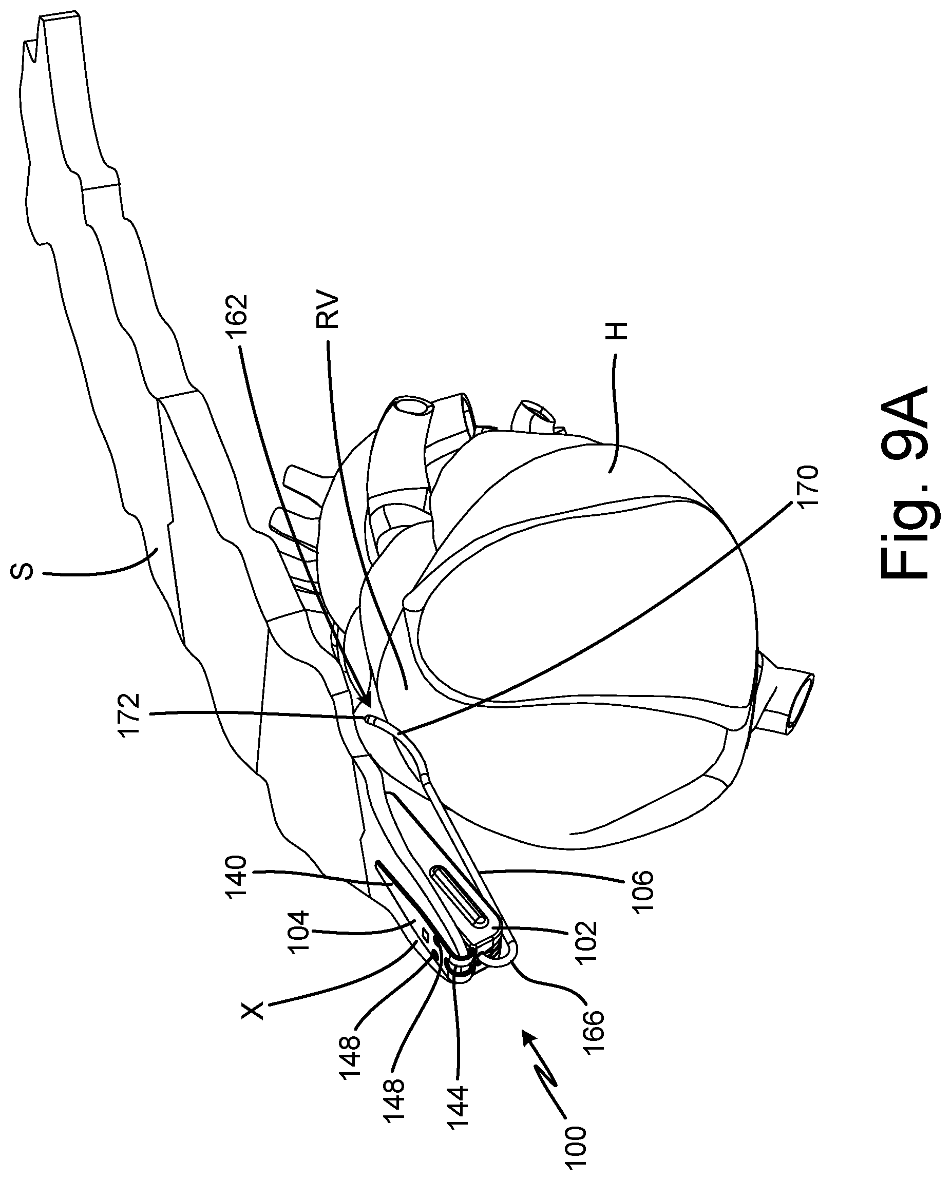 Patent US12508434 Figure 11 – Method of injecting subcutaneous device