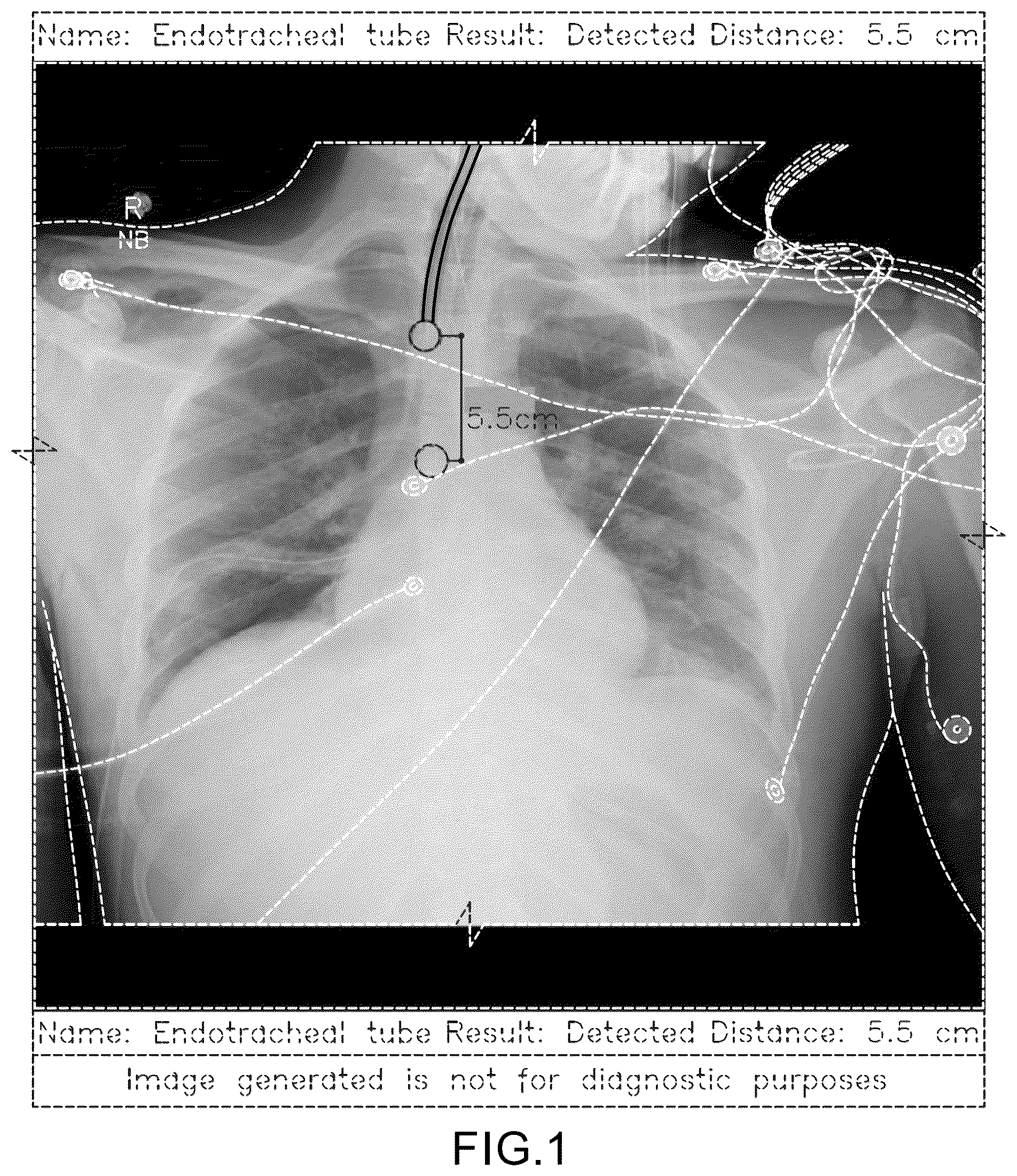 Patent USD1077854 — Display screen or portion thereof with a computer generated graphical user interface for placement of a medical tube or line — Figure 1