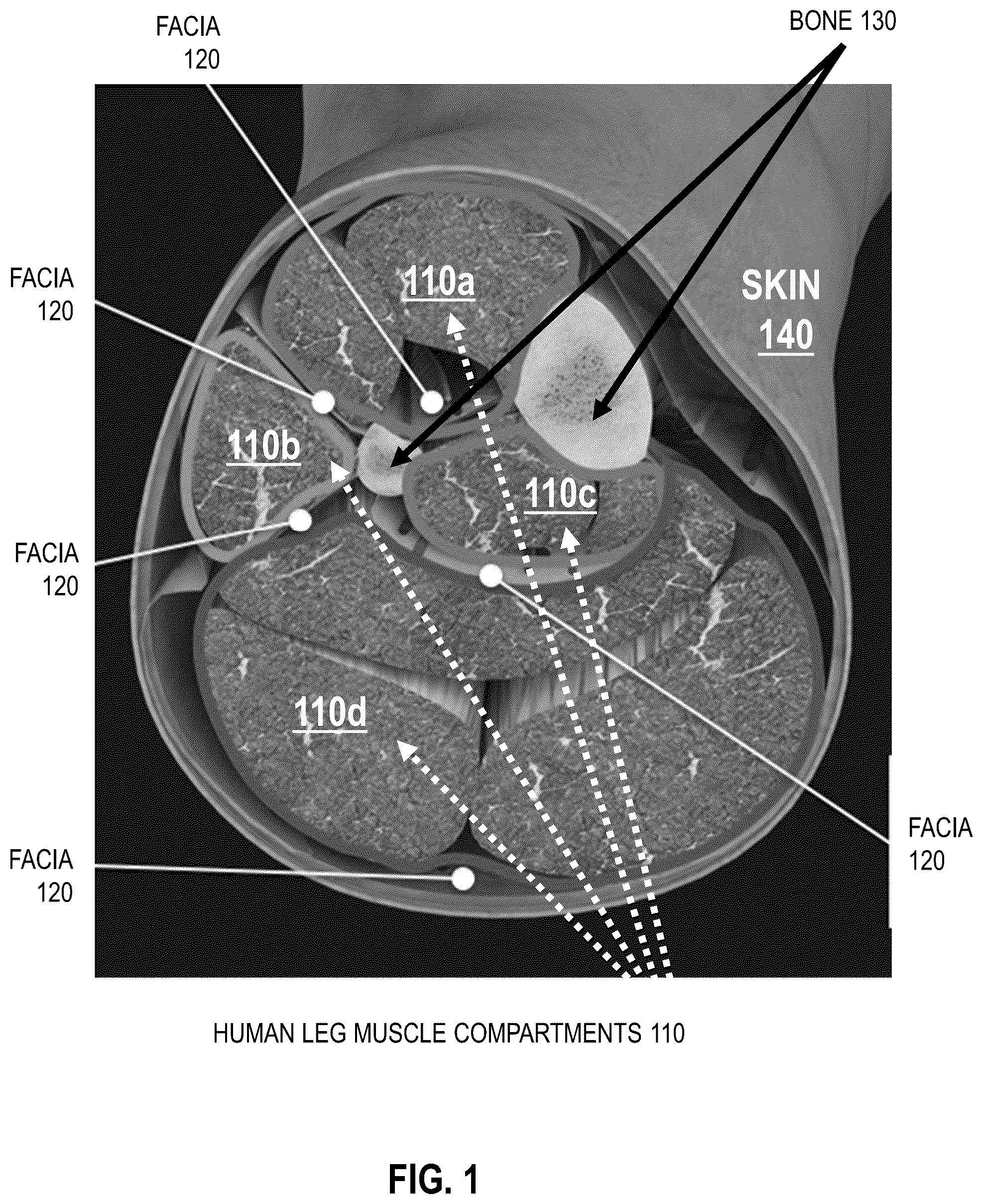 Patent US12551125 — Handheld non-invasive compartment syndrome detector — Figure 1