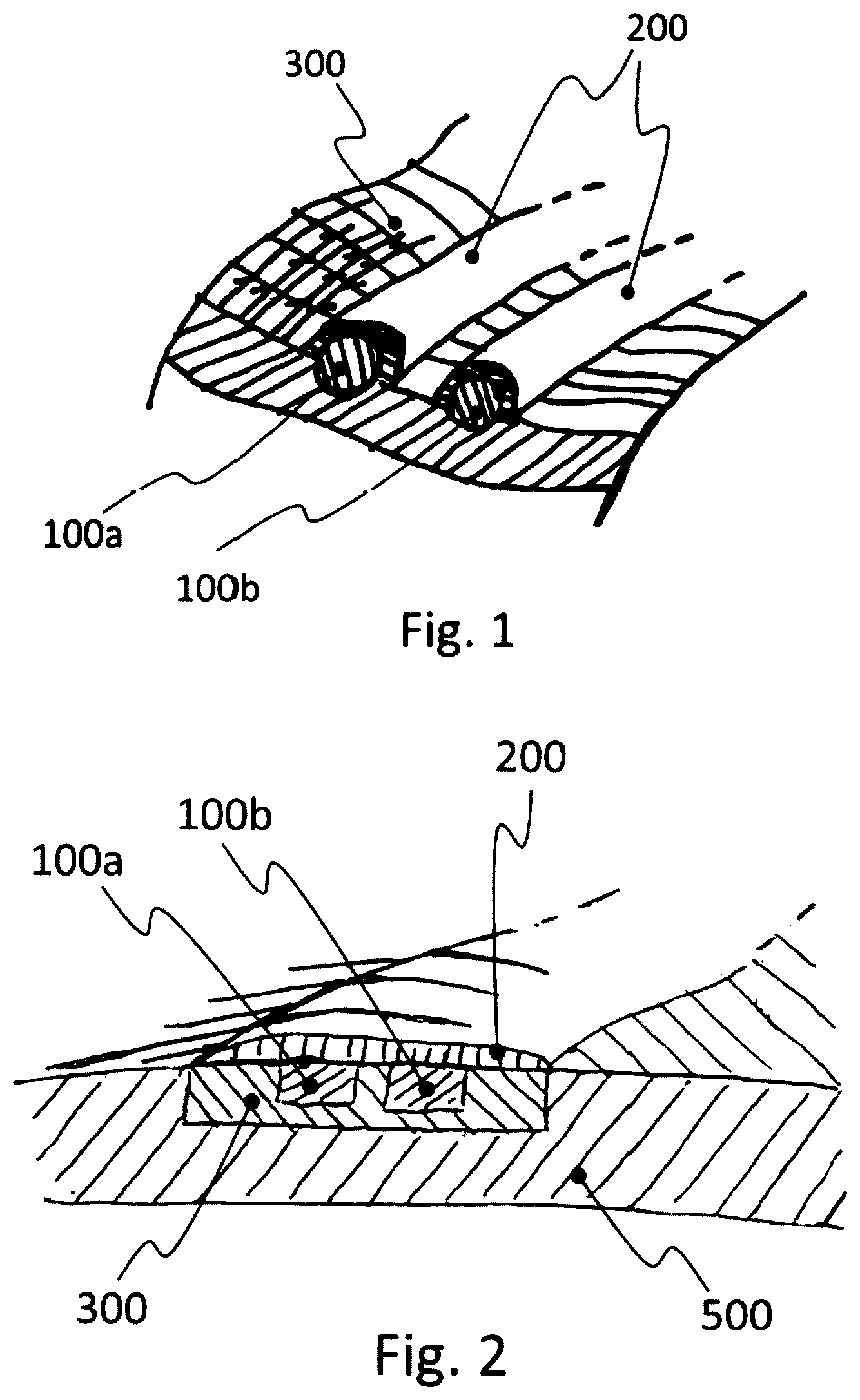 Patent US12551146 — Biosensor and related wound dressing system — Figure 1