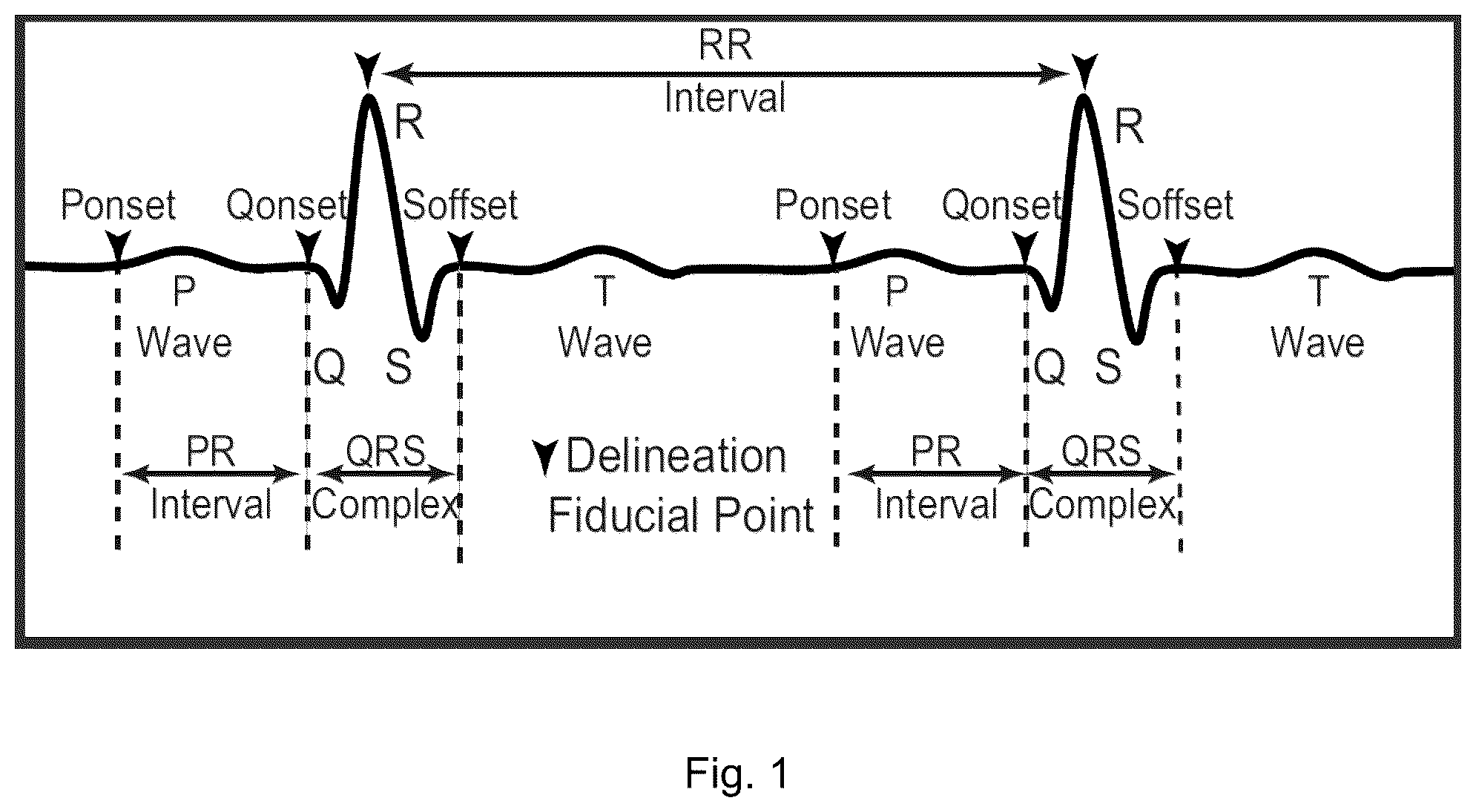 Patent US12551155 — Electrocardiogram sensing and processing — Figure 1
