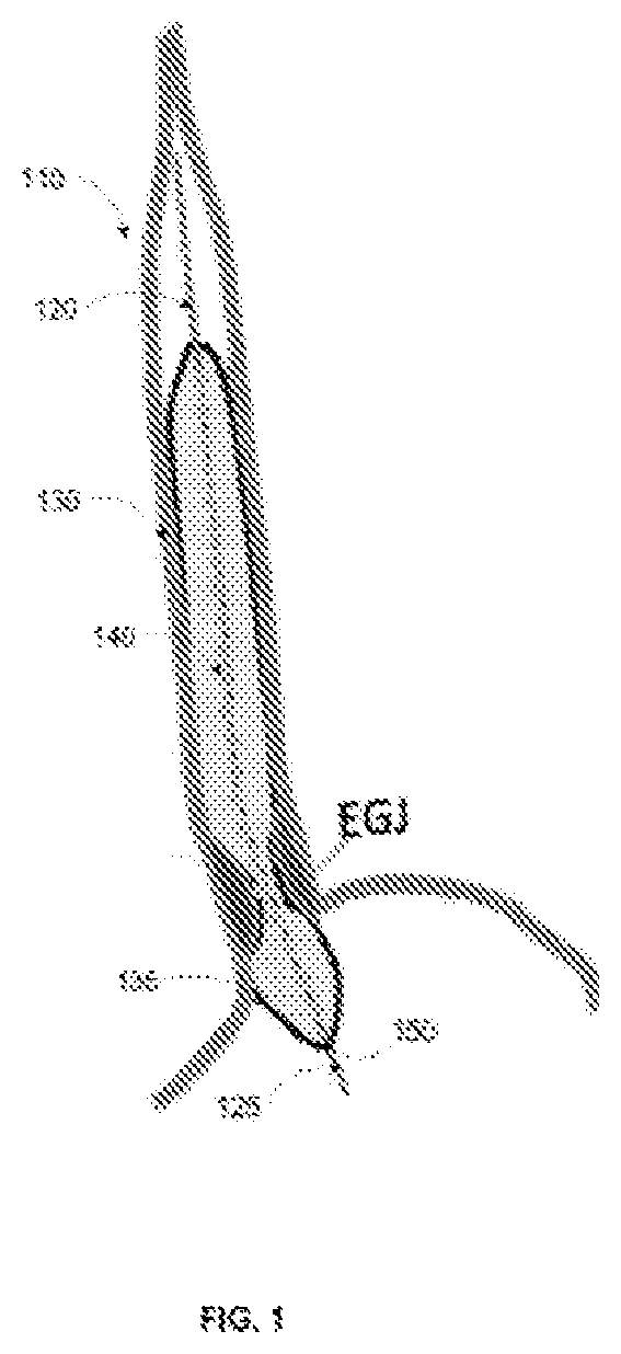 Patent US12551159 — Analysis and display of functional lumen imaging probe (FLIP) data — Figure 1