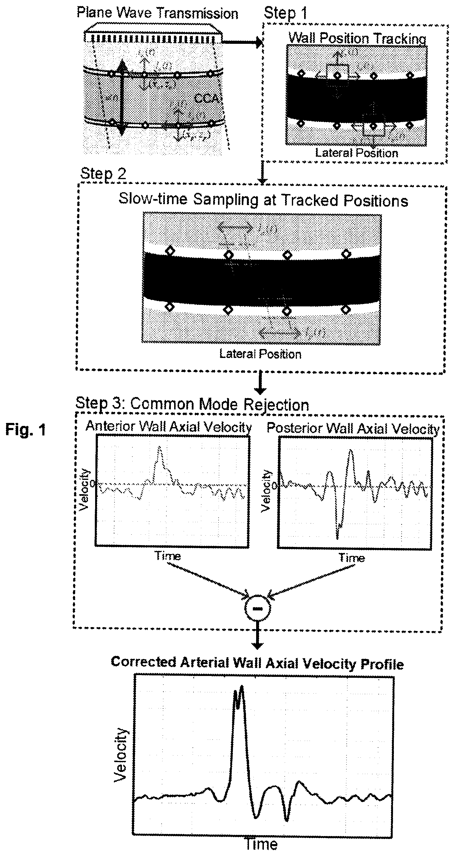 Patent US12551196 Figure 1 – Measuring pulse wave velocity using ultrasound