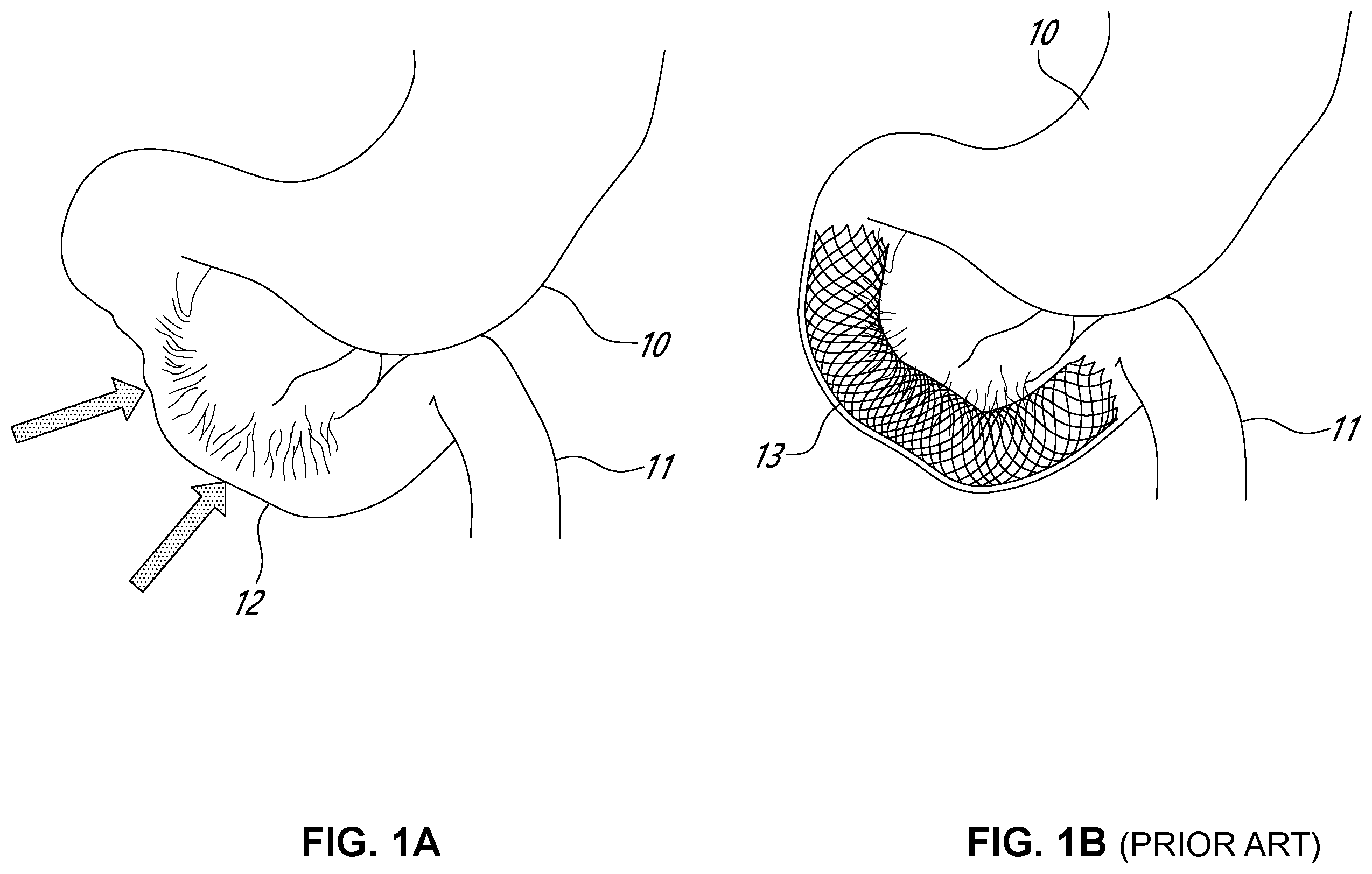 Patent US12551216 — Double-balloon catheter — Figure 1