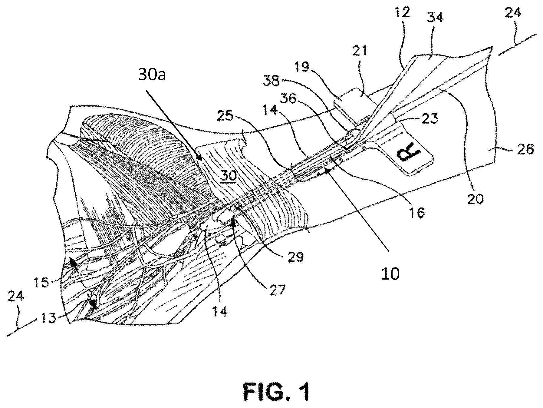 Patent US12551229 — Integrated endoscopic ligament release device with dual handles — Figure 1