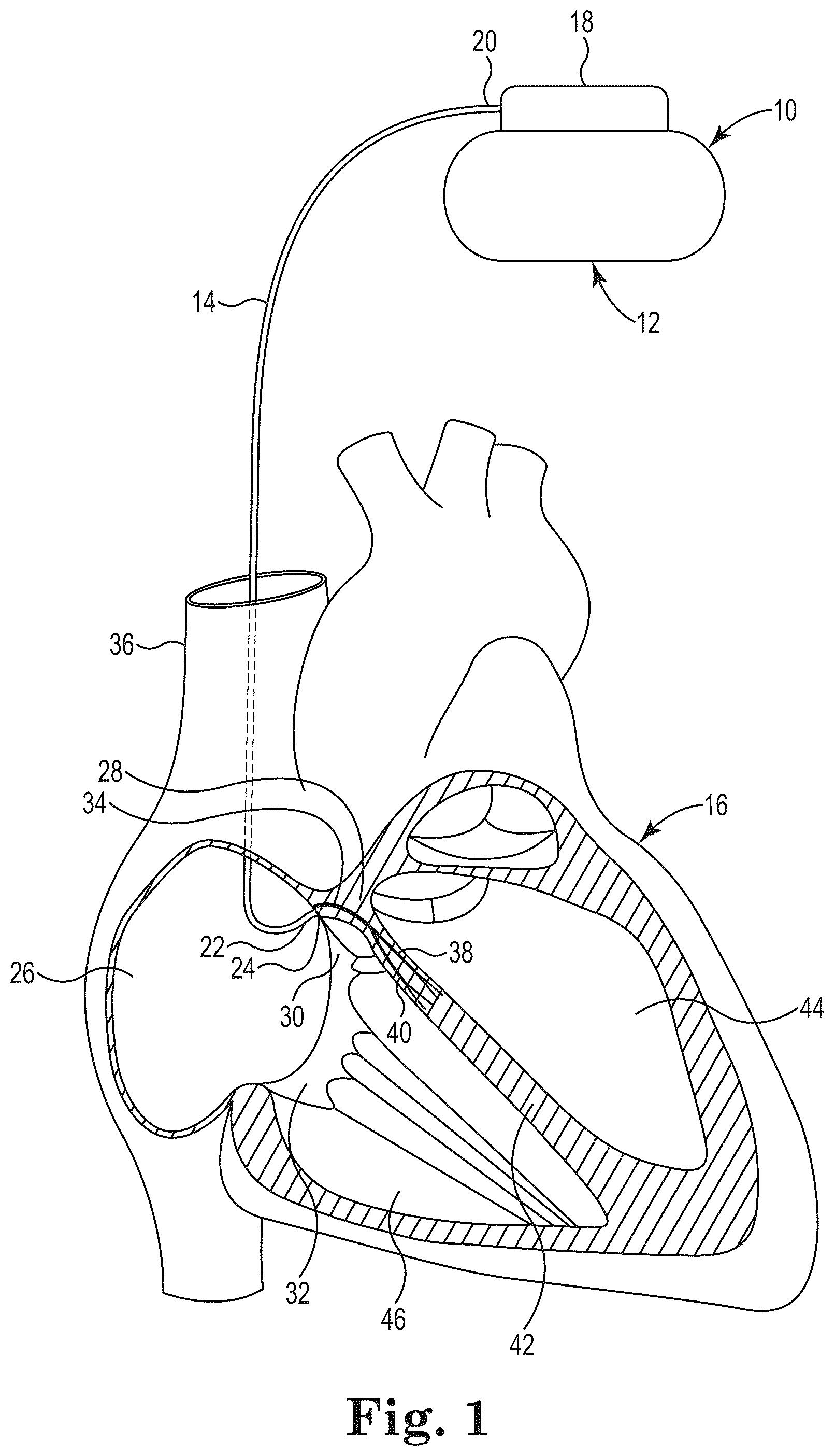Patent US12551235 Figure 1 – Bundle of His lead delivery catheter, system and method