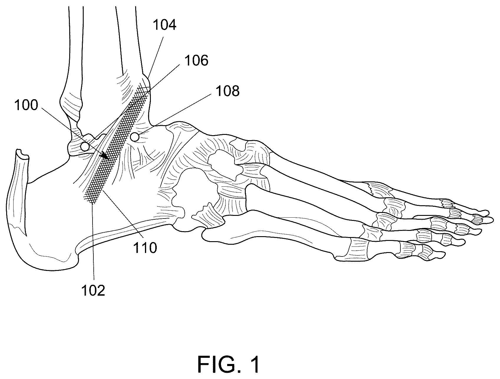 Patent US12551238 — Fiber implant with interwoven different materials — Figure 1