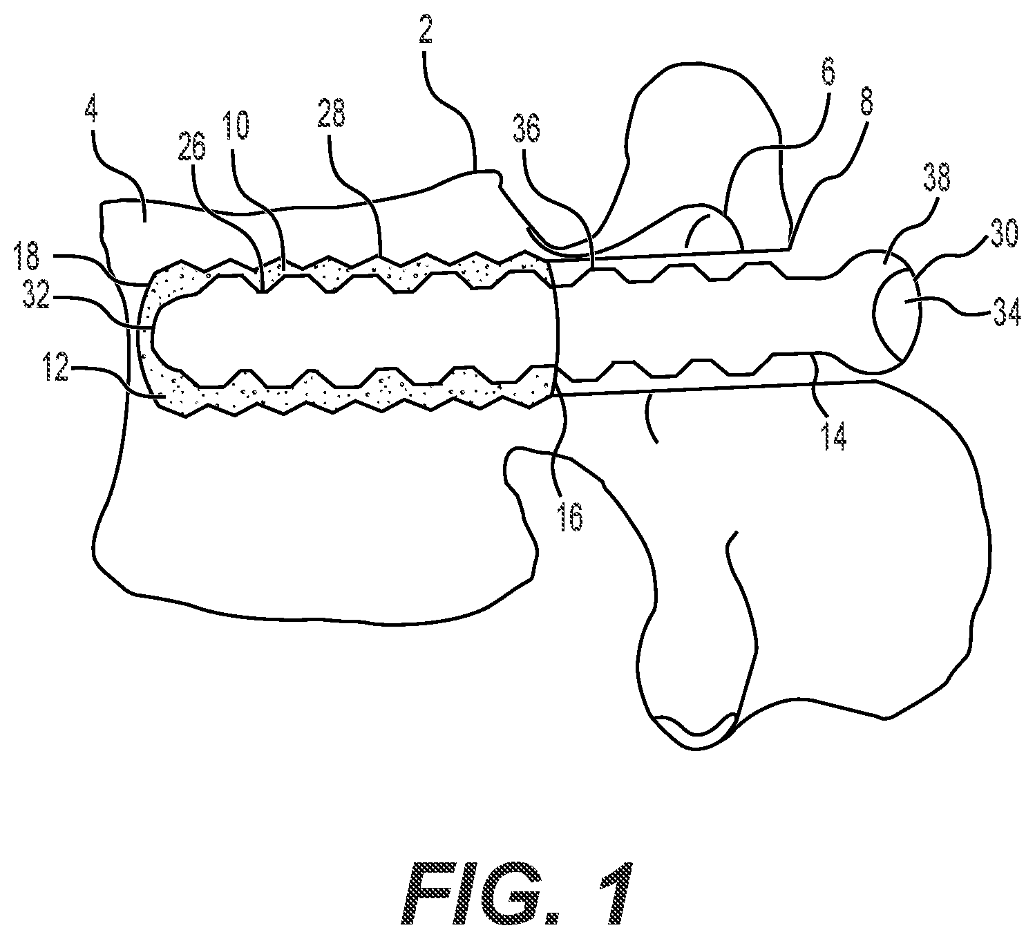 Patent US12551241 — Expandable bone core for pedicle screw fixation — Figure 1