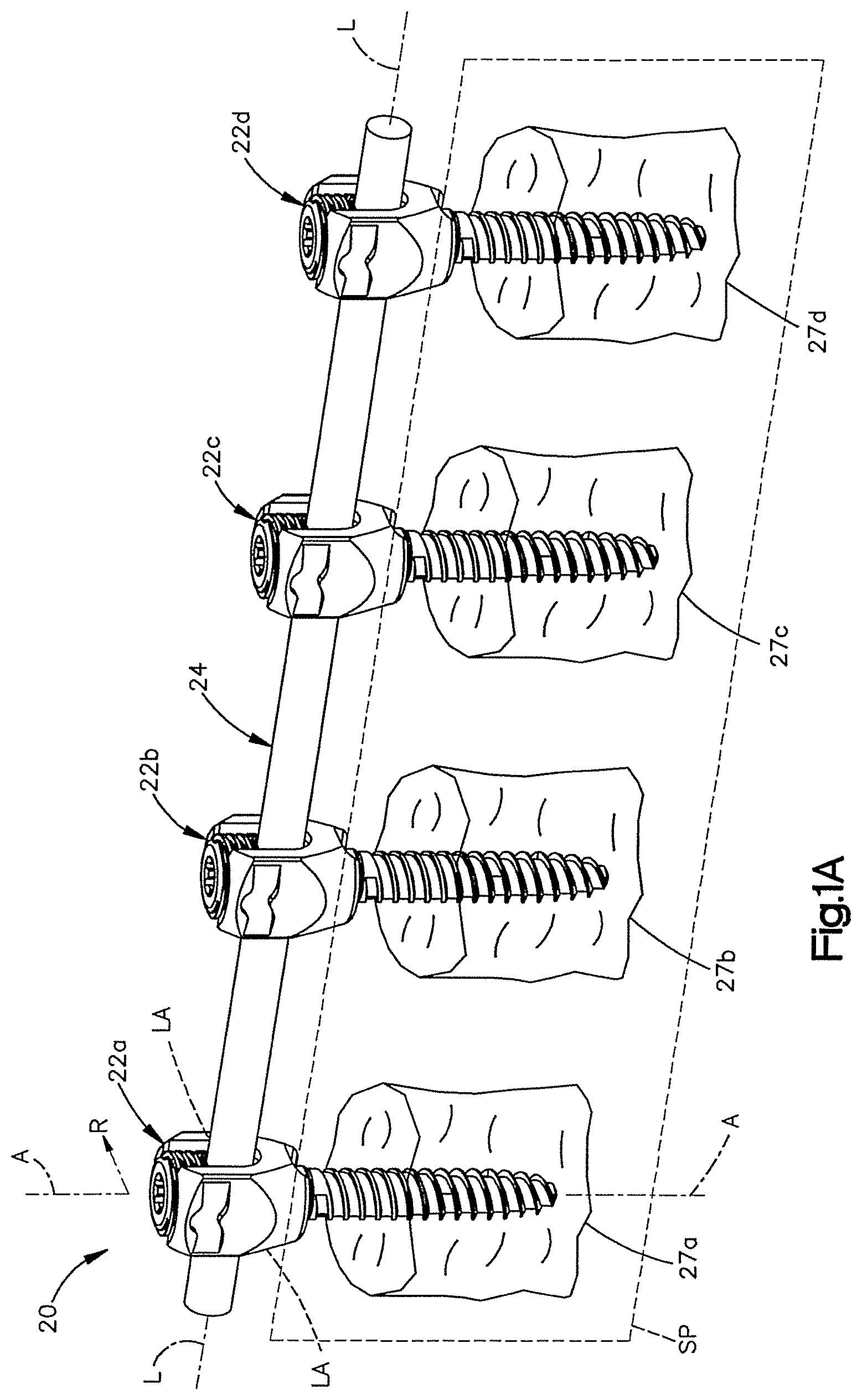 Patent US12551245 Figure 1 – Uni-planer bone fixation assembly
