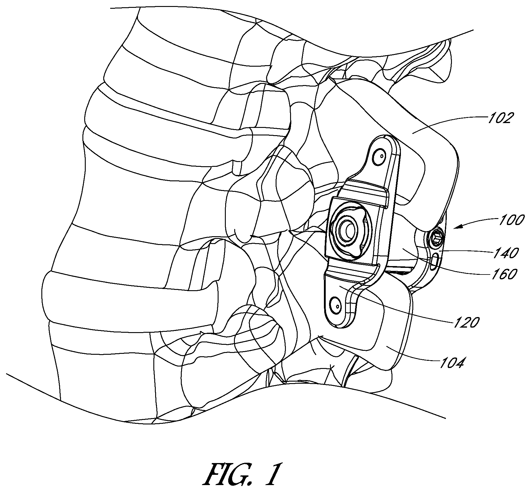 Patent US12551246 — Apparatus and method of treating spinous processes — Figure 1